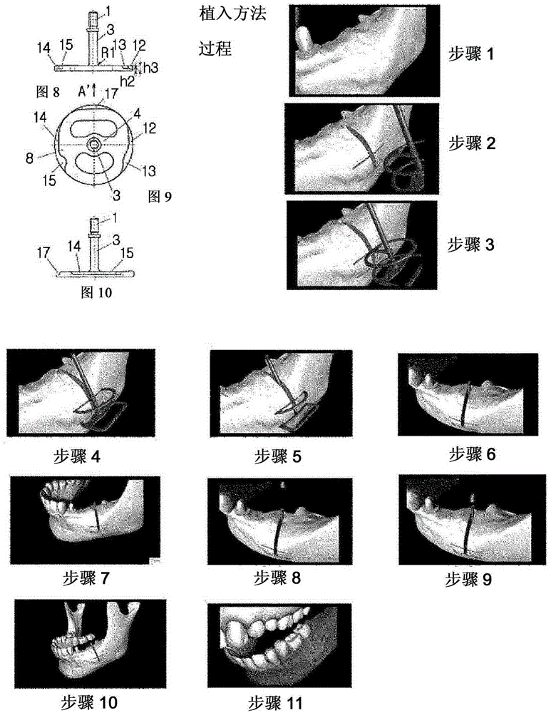 Tooth implant