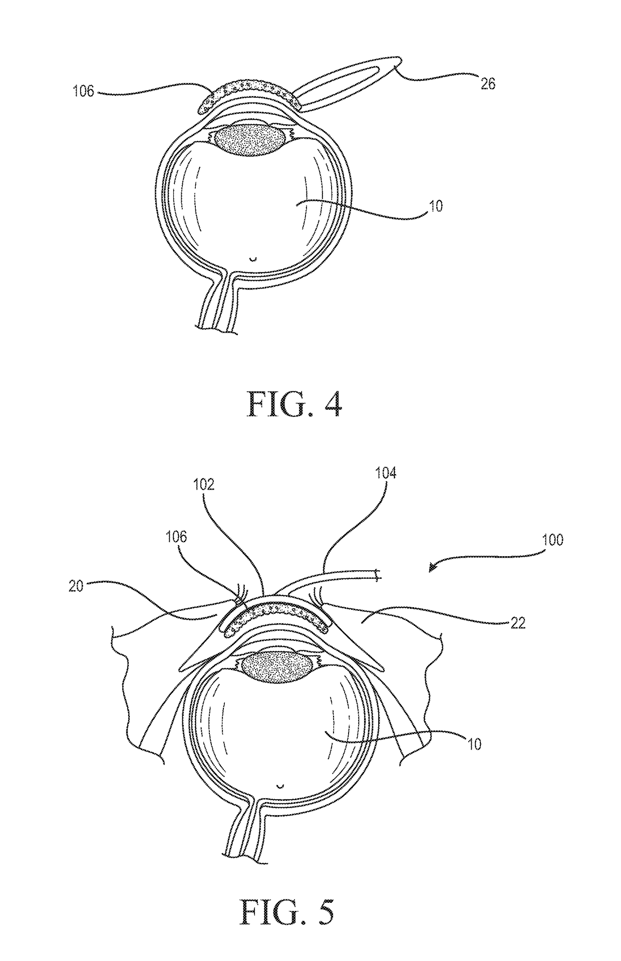 System and method for the delivery of medications or fluids to the eye