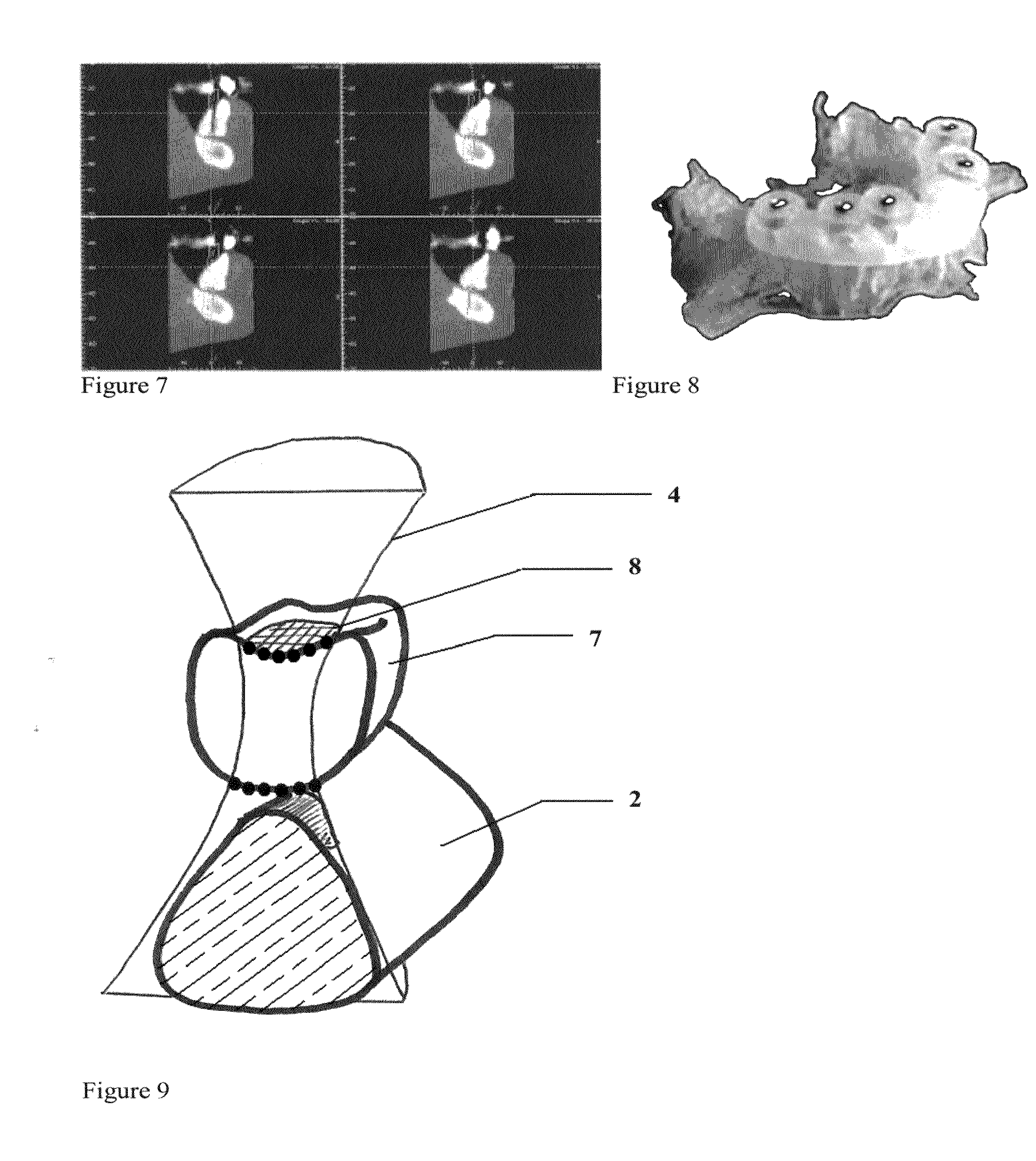 Method for (semi-) automatic dental implant planning