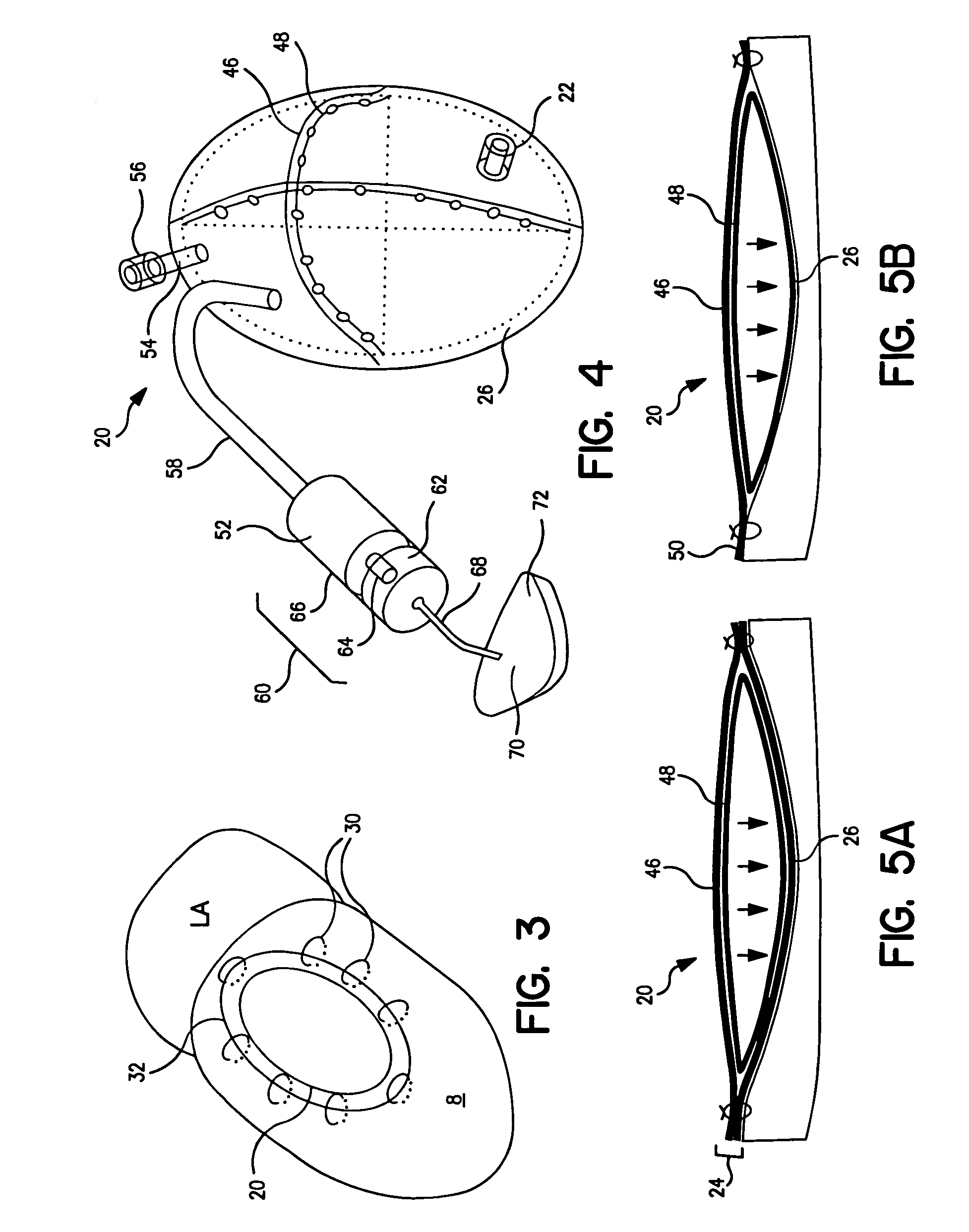 Systems for and methods of repair of atrioventricular valve regurgitation and reversing ventricular remodeling