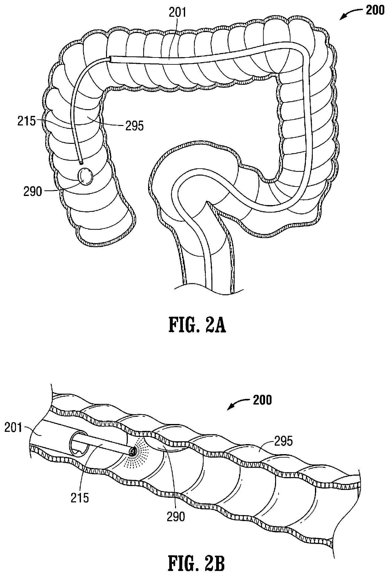 Multi-lumen-catheter retractor system for a minimally-invasive, operative gastrointestinal treatment