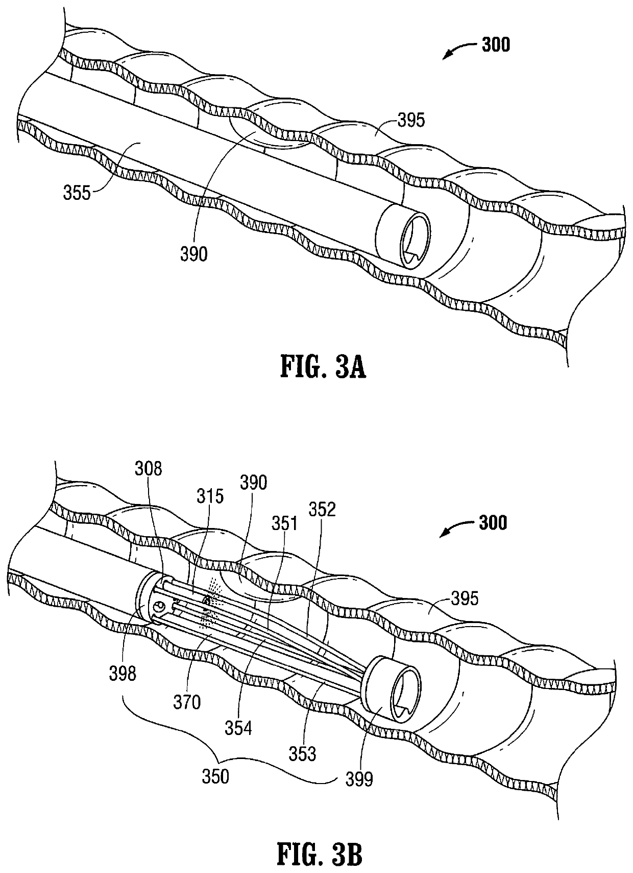 Multi-lumen-catheter retractor system for a minimally-invasive, operative gastrointestinal treatment