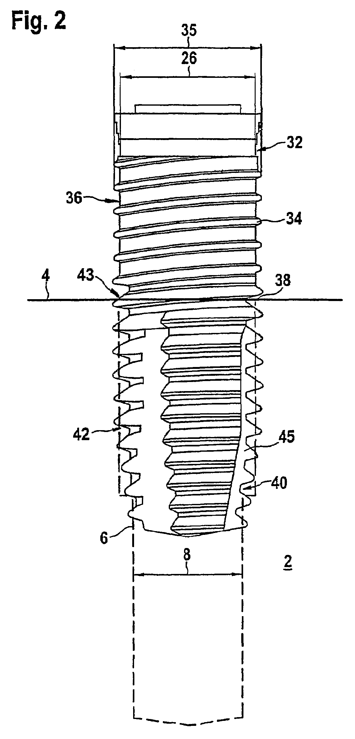 Implant system