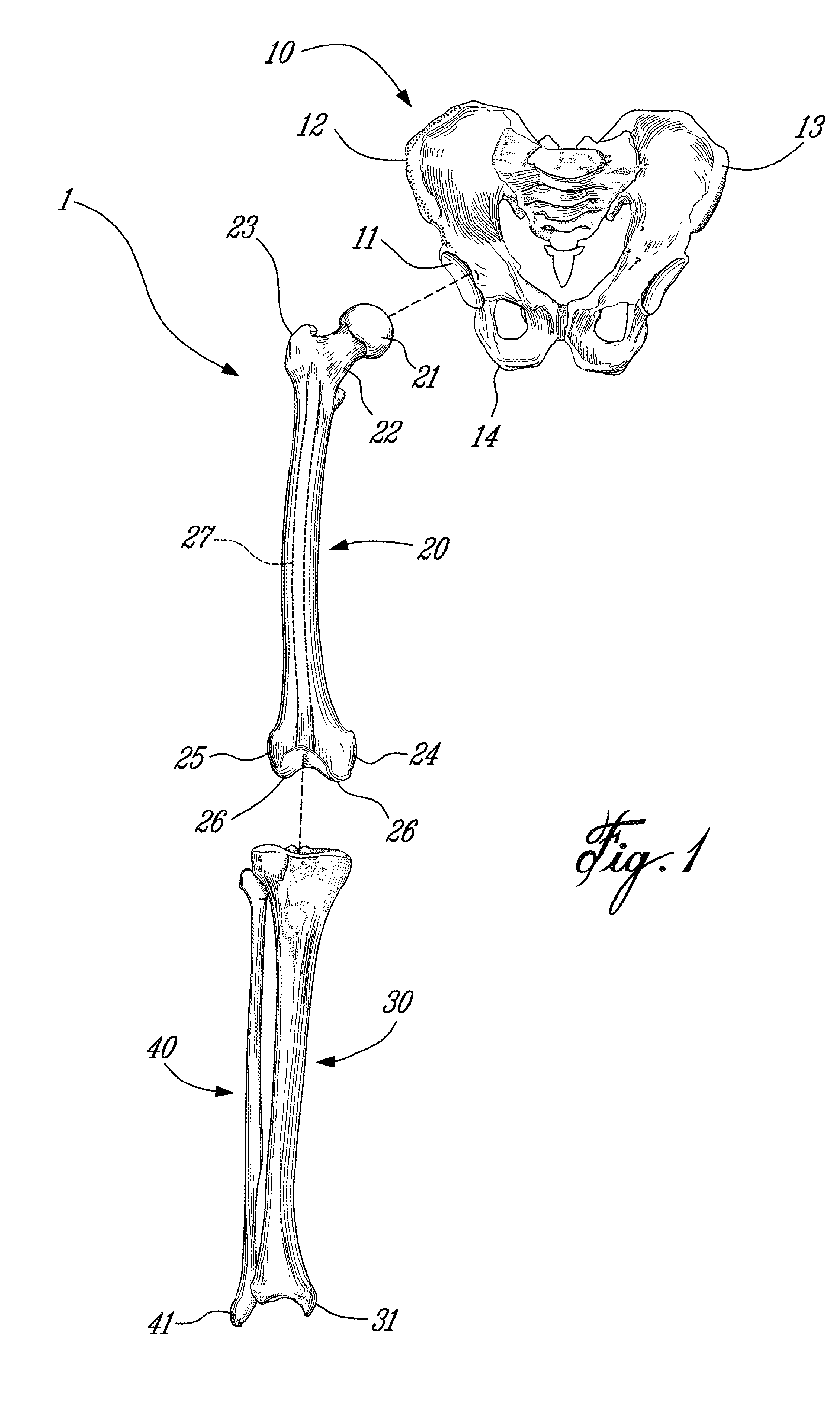 Computer-assisted hip replacement surgery