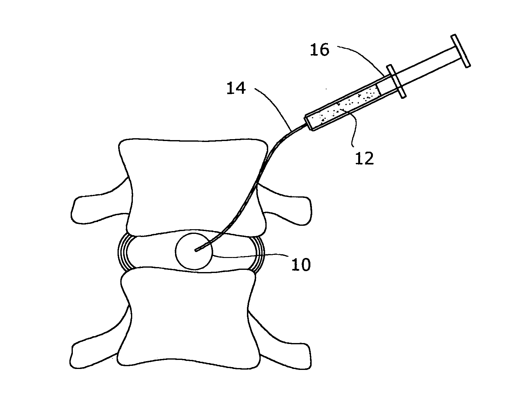 Inflatable nuclear prosthesis