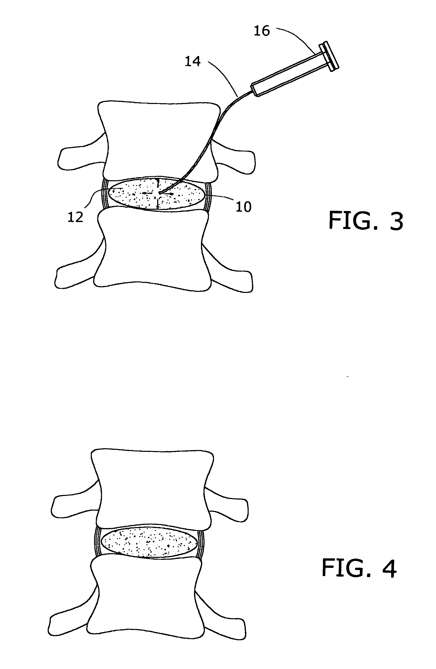 Inflatable nuclear prosthesis