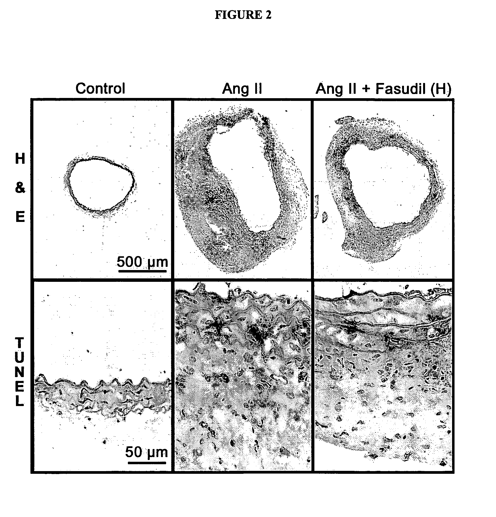 Use of Rho-kinase inhibitors in the treatment of aneurysm and cardiac hypertrophy