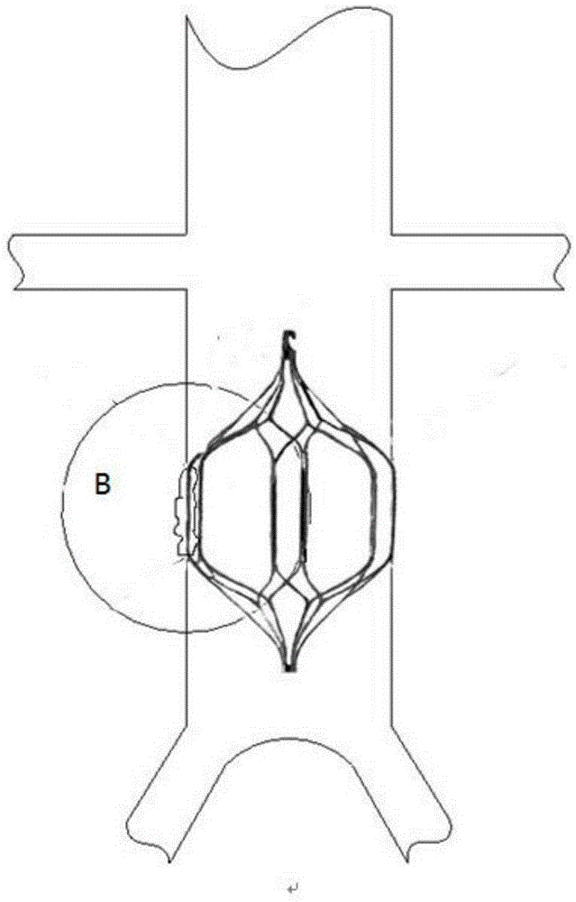 Thrombus filter