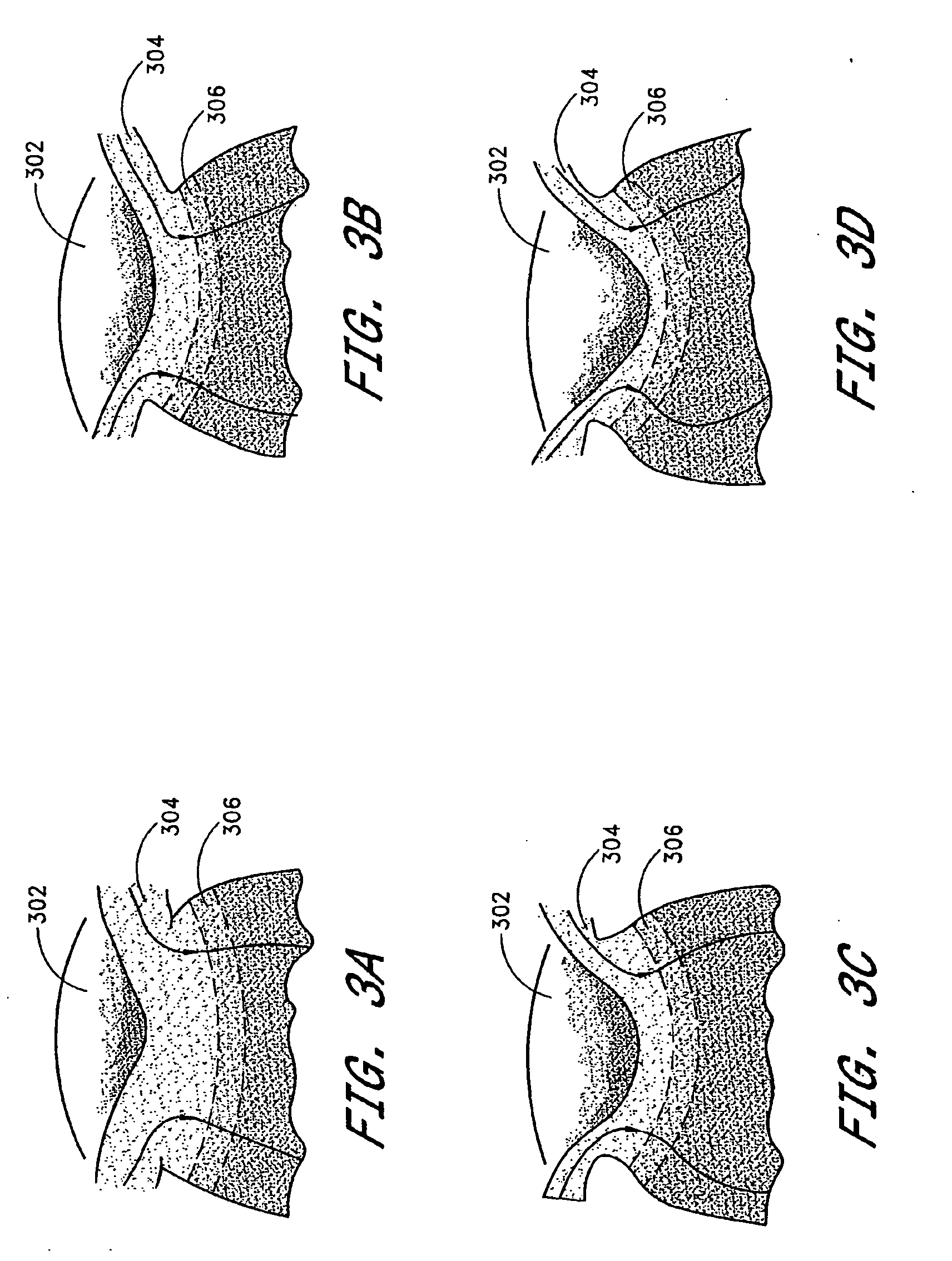 Minimally invasive glaucoma surgical instrument and method