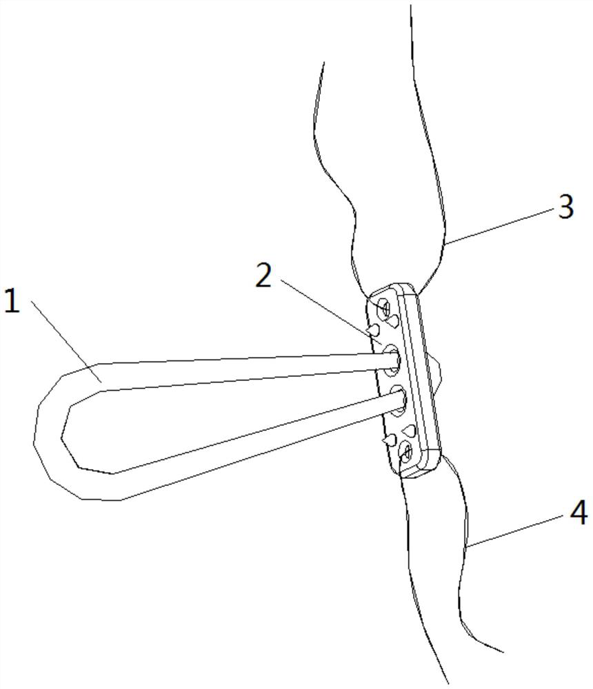 Titanium plate with loop