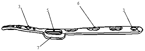 Distal fibula C-type bone fracture band lateral wing locking setting structure