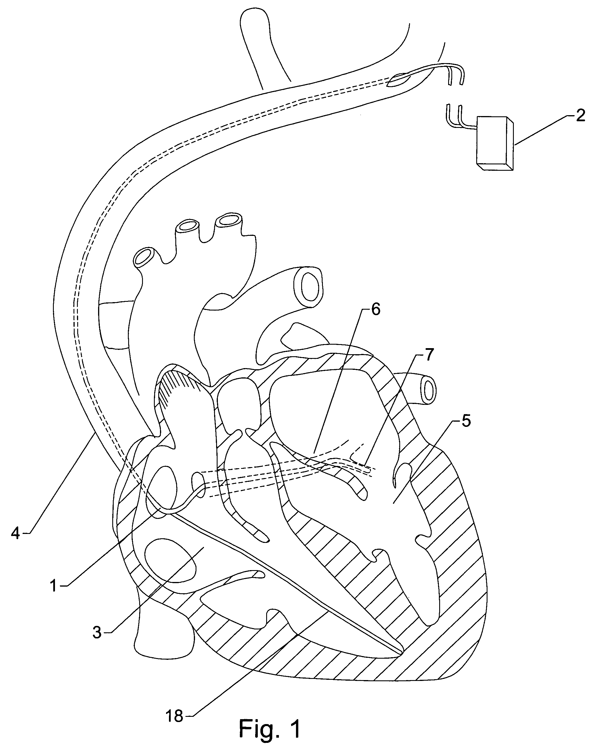 Method and apparatus for adjusting interventricular delay based on ventricular pressure