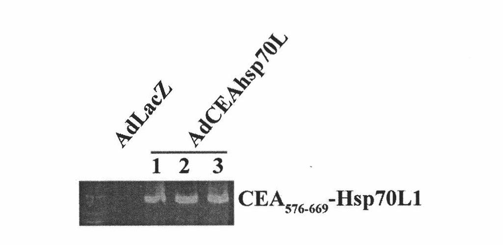 Recombinant adenovirus with fusion protein gene and preparation method and application thereof