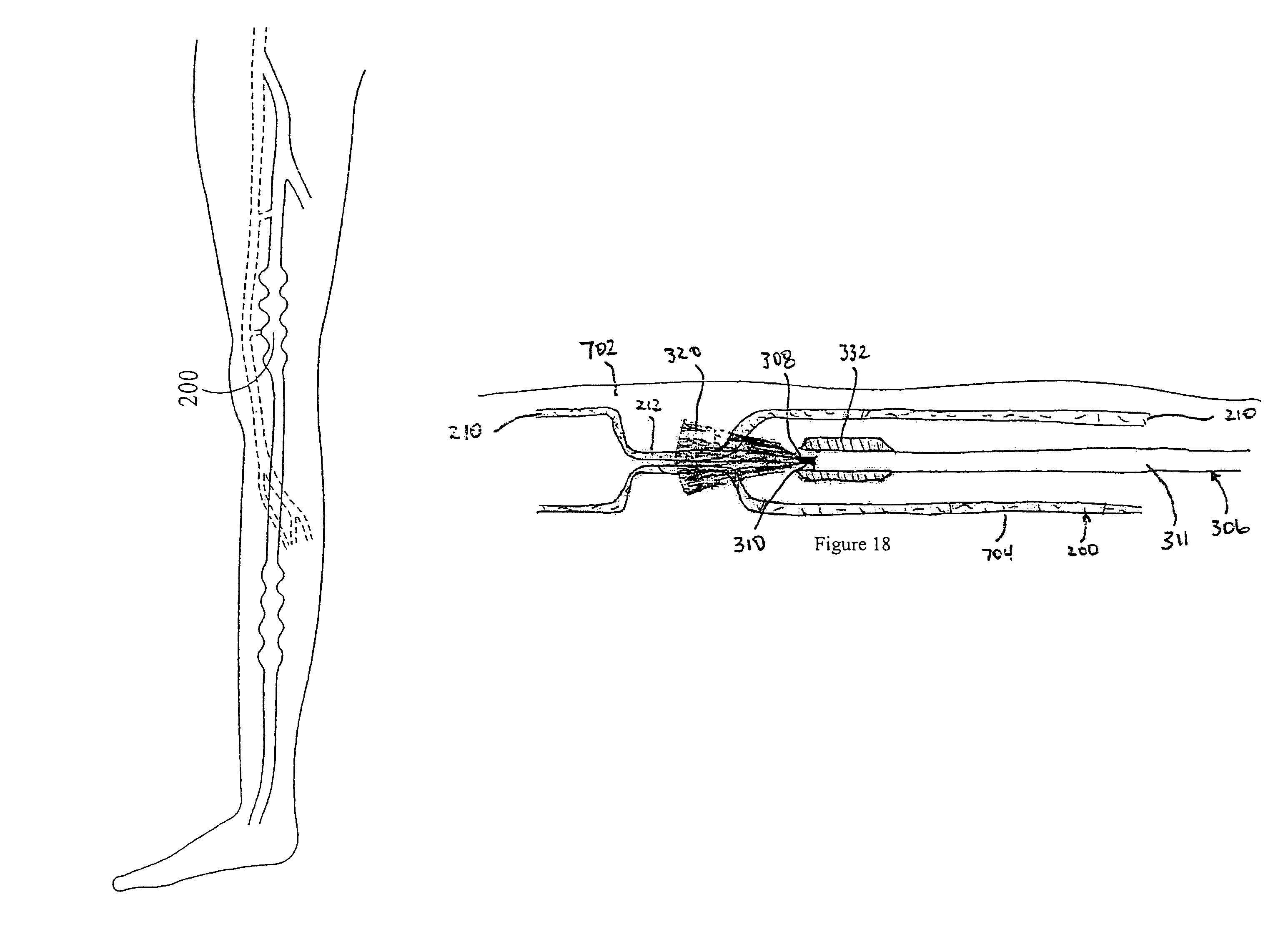 Endovenous closure of varicose veins with mid infrared laser