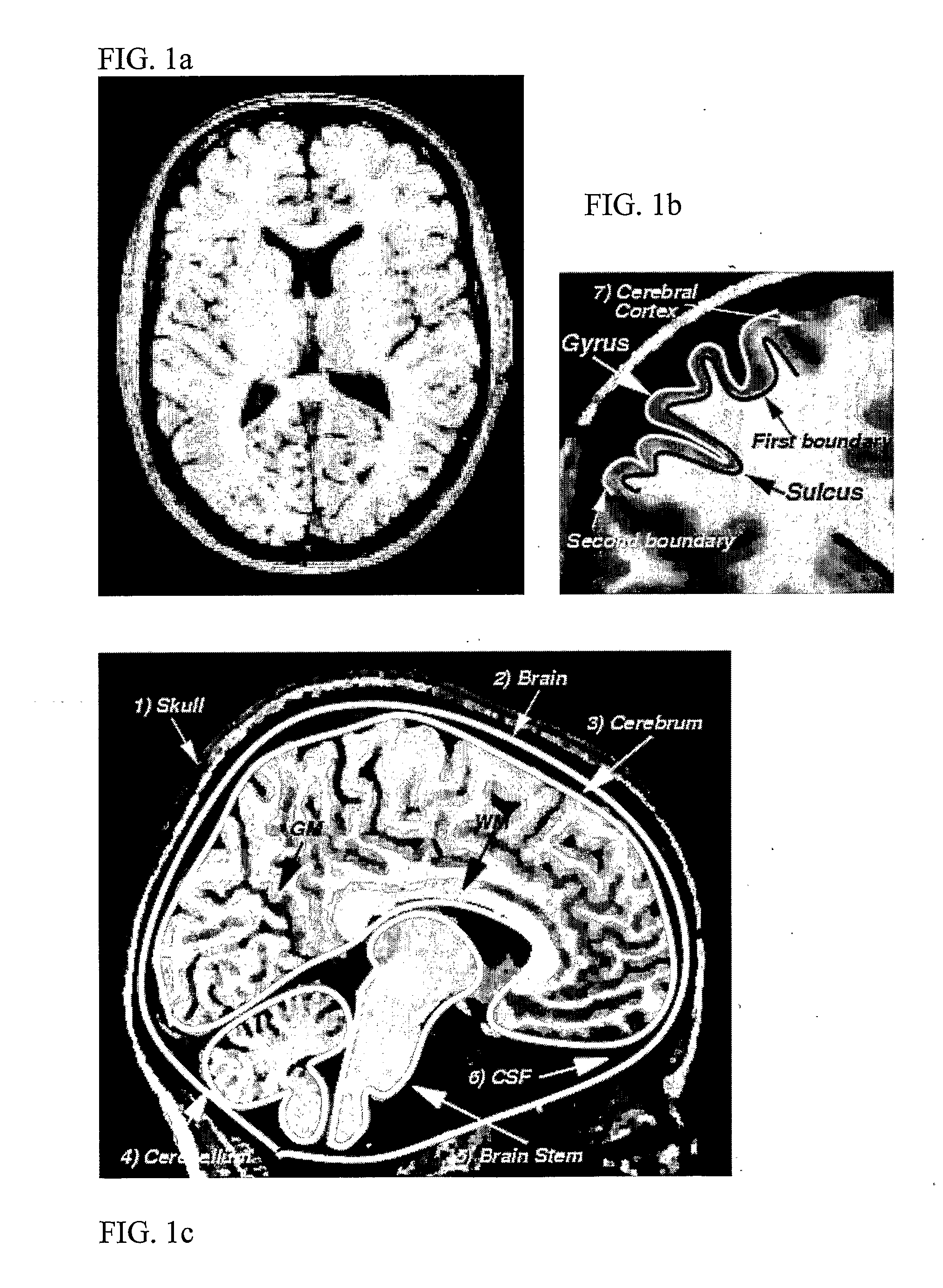 Computerised Cortex Boundary Extraction From Mr Images