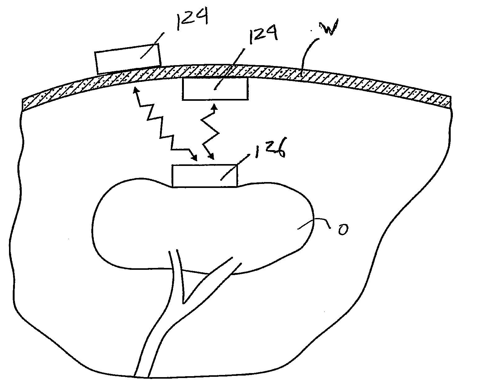 Surgical devices for manipulating tissue