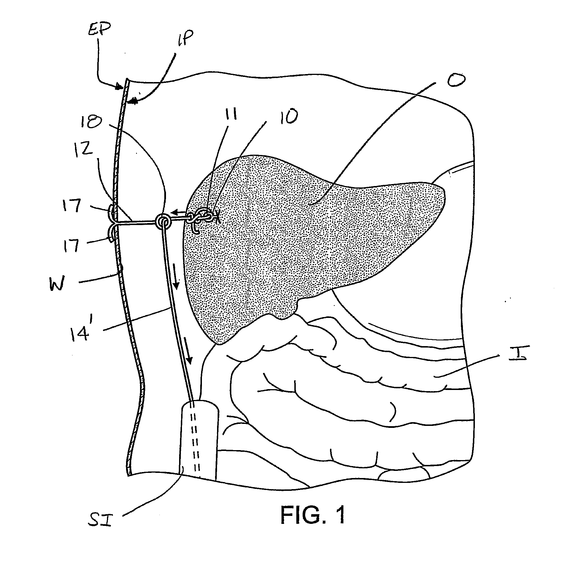 Surgical devices for manipulating tissue