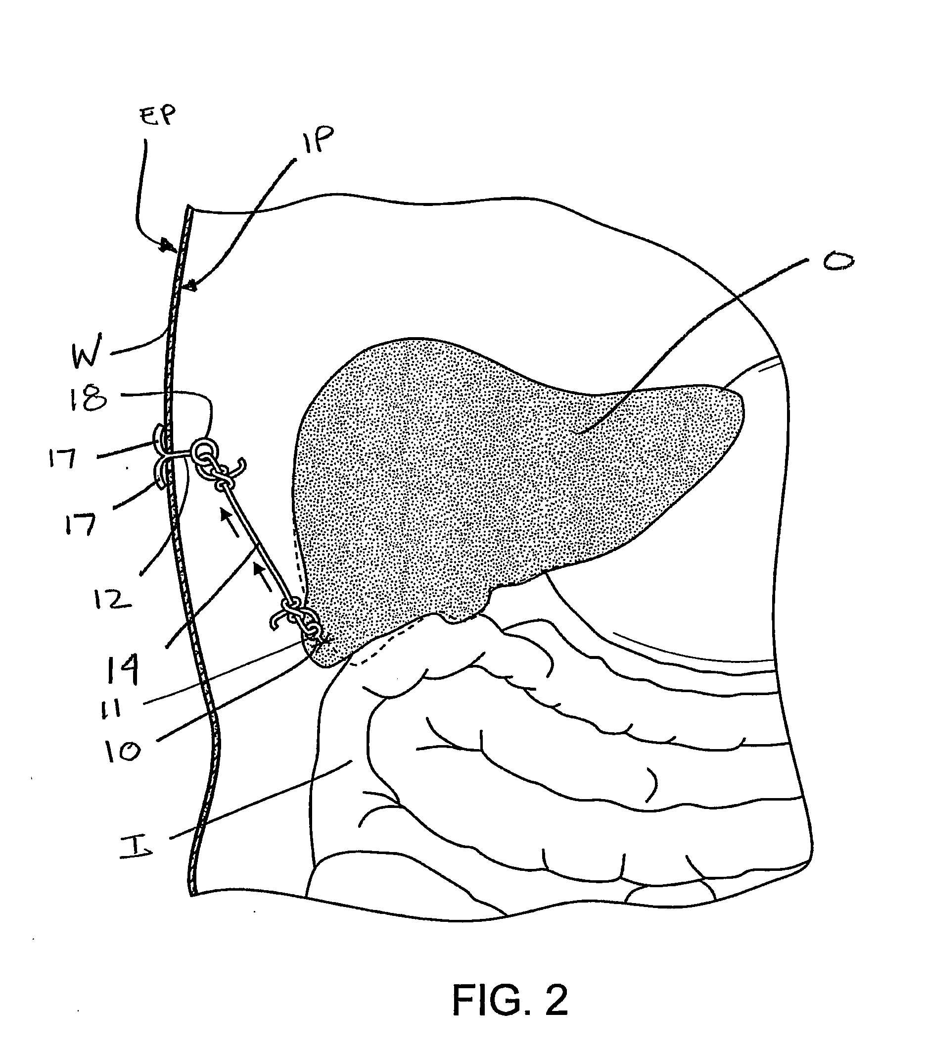 Surgical devices for manipulating tissue