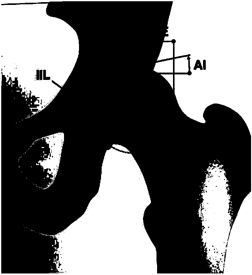 Method for preparing acetabulum supplementary material