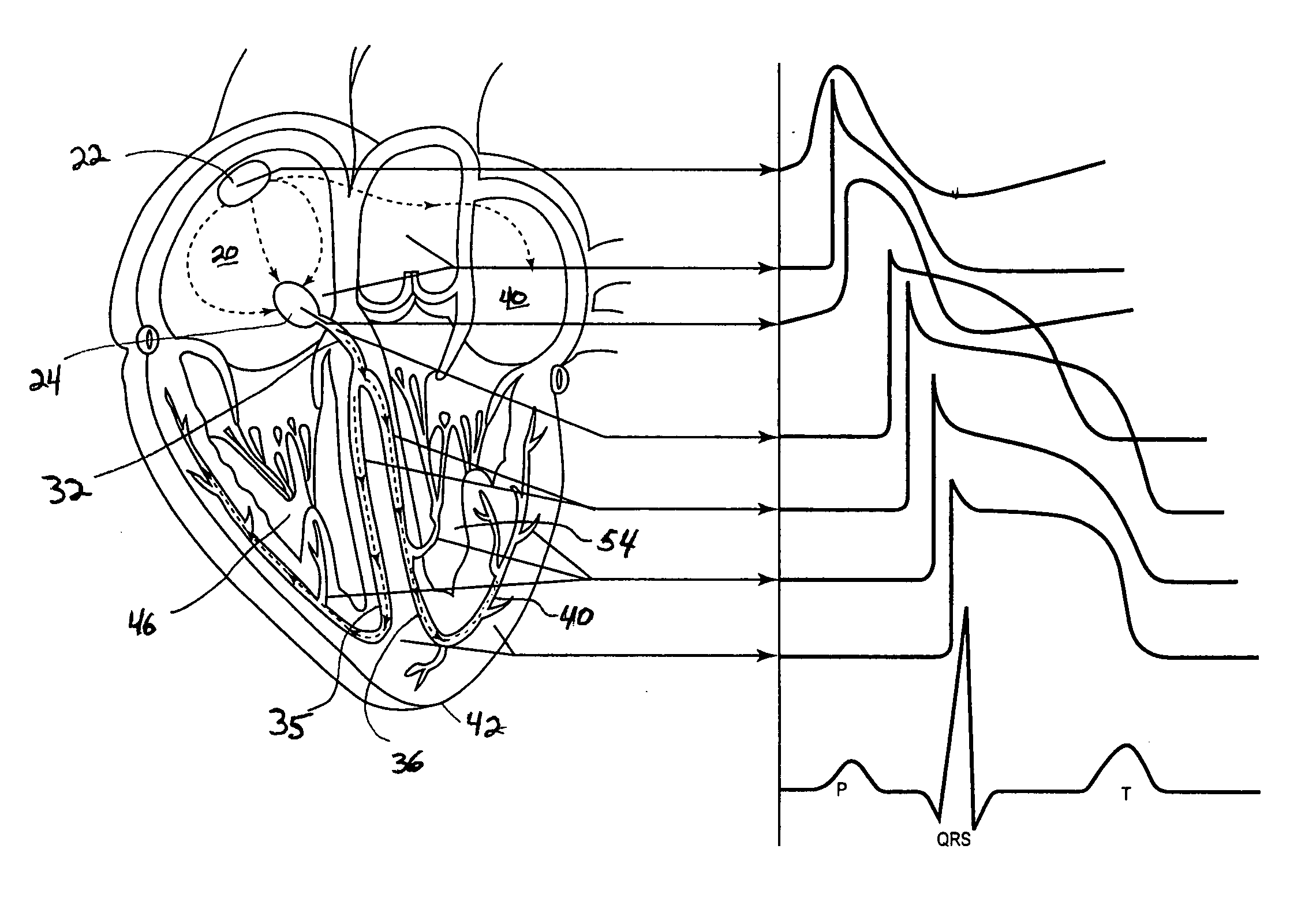 System and method of AV interval selection in an implantable medical device