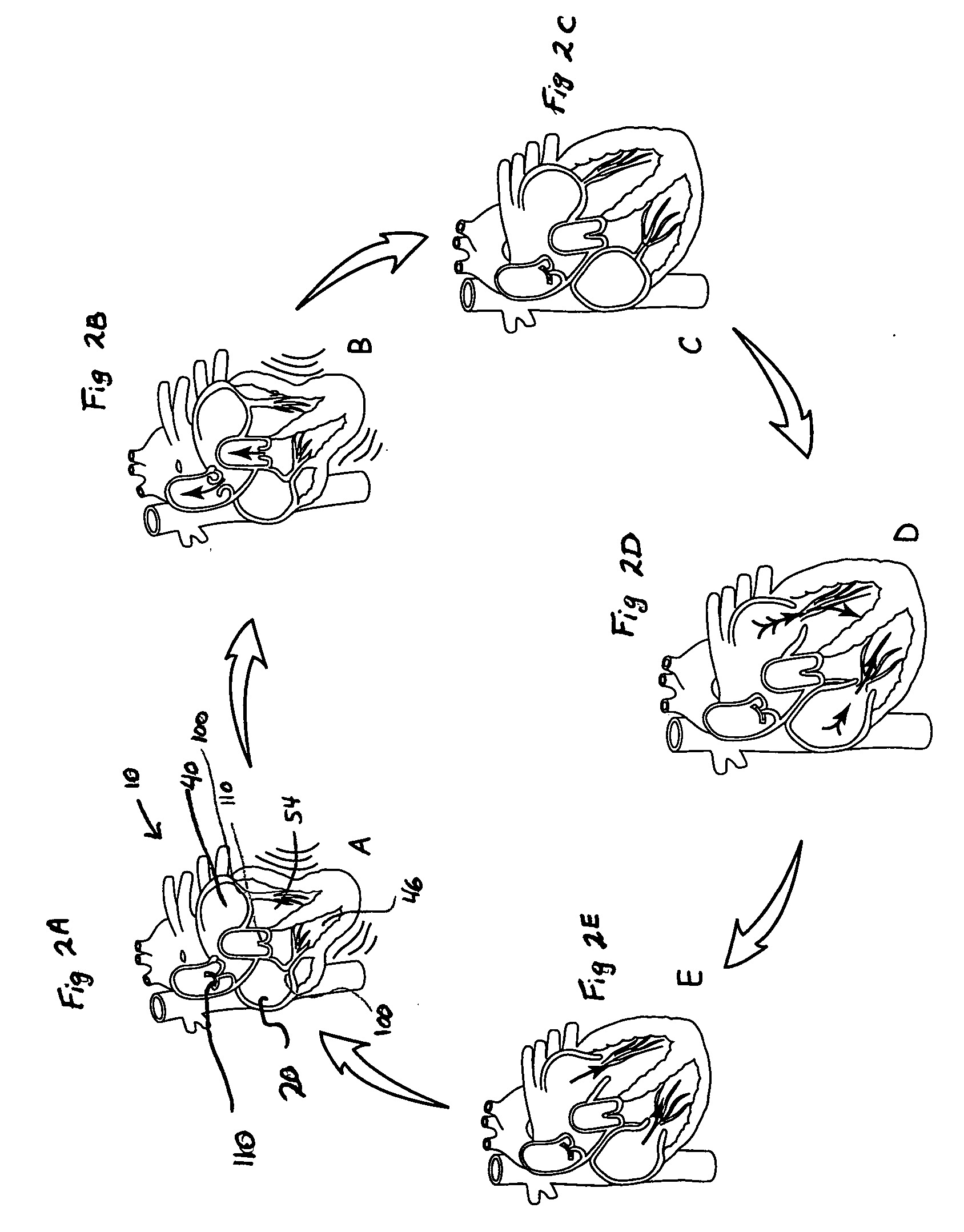 System and method of AV interval selection in an implantable medical device