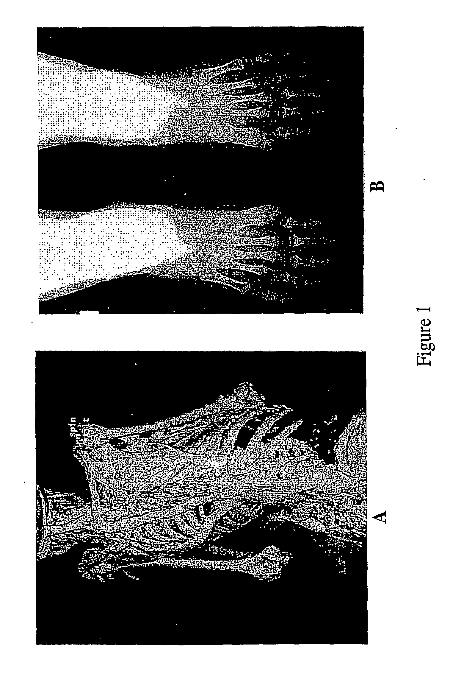 Mutated acvr1 for diagnosis and treatment of fibrodyplasia ossificans progressiva (FOP)