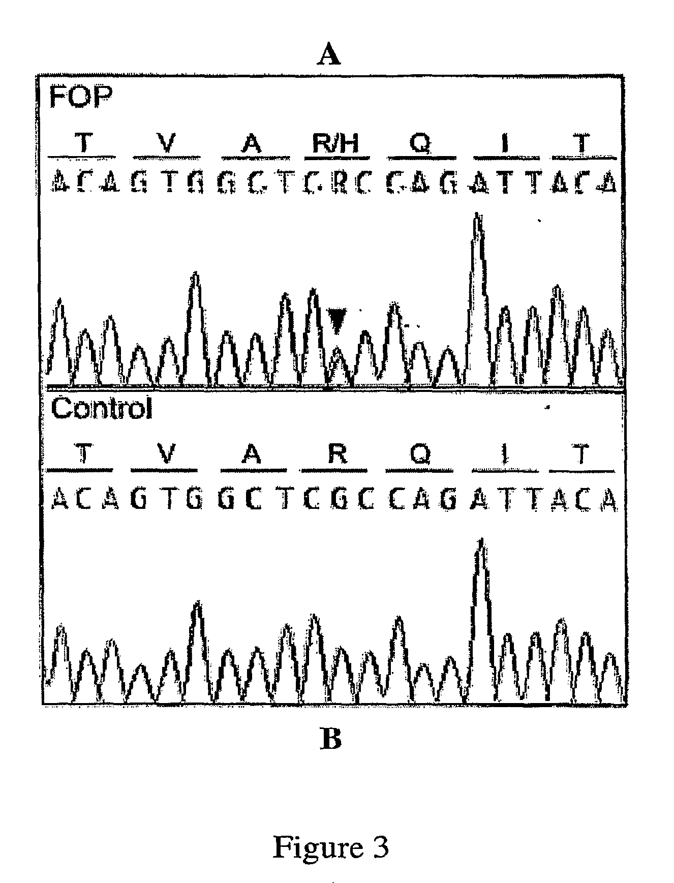 Mutated acvr1 for diagnosis and treatment of fibrodyplasia ossificans progressiva (FOP)