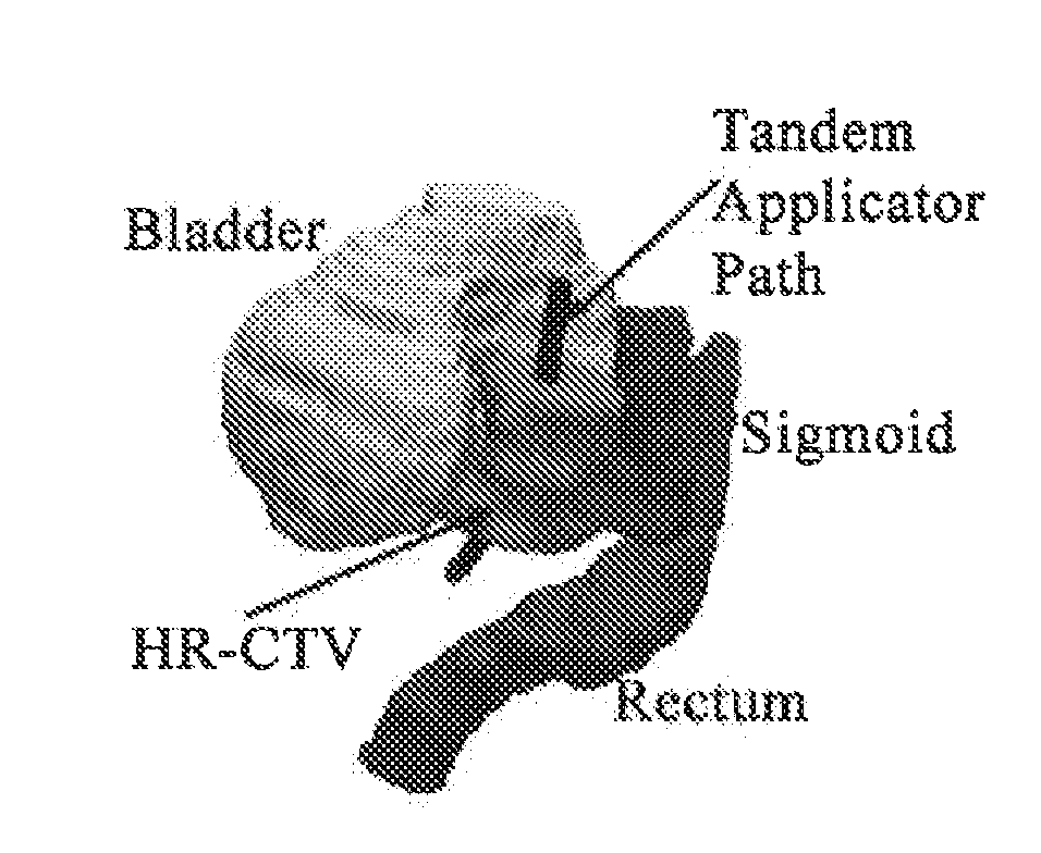 Advanced rotating-shield brachytherapy and planning of the same