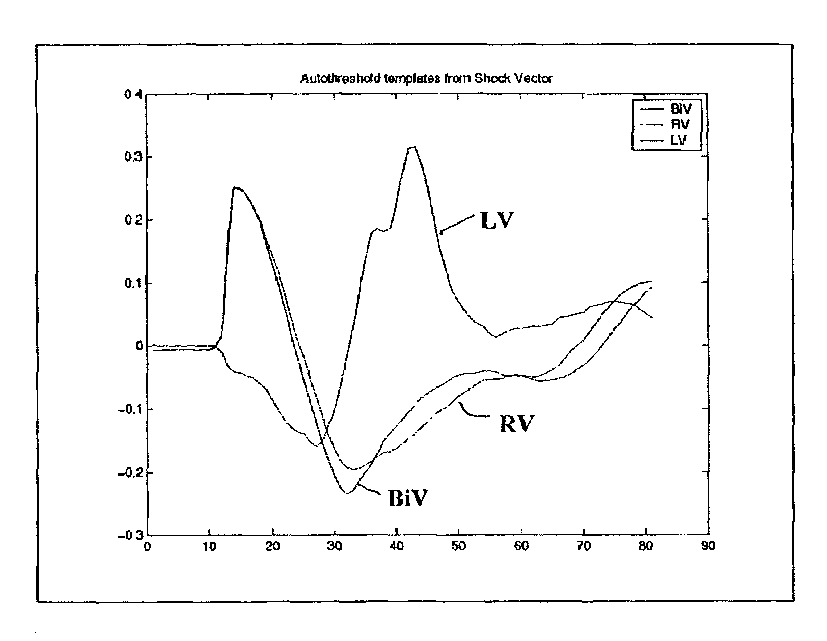 Template-based capture verification for multi-site pacing