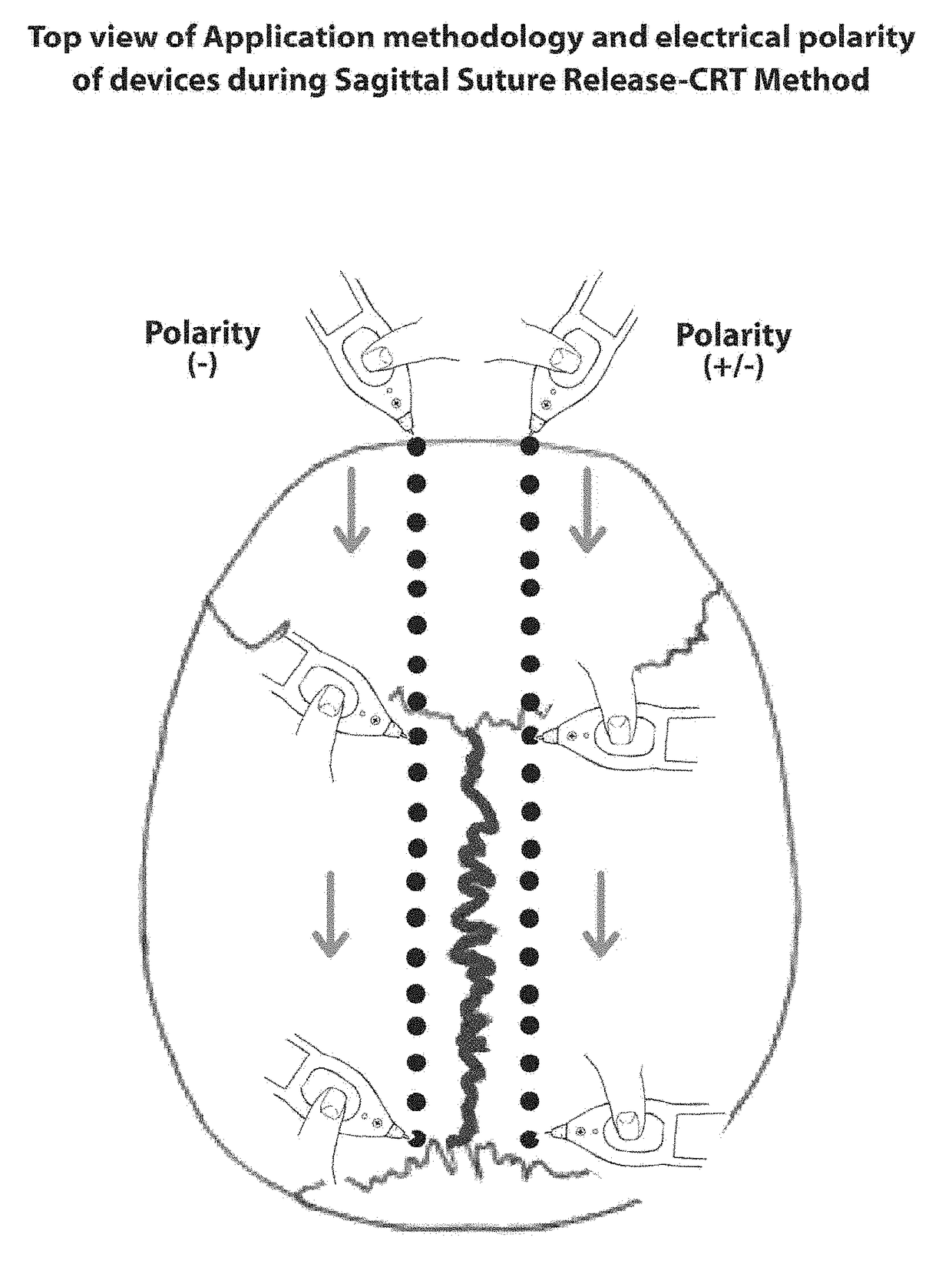 Method and system for cranial suture release