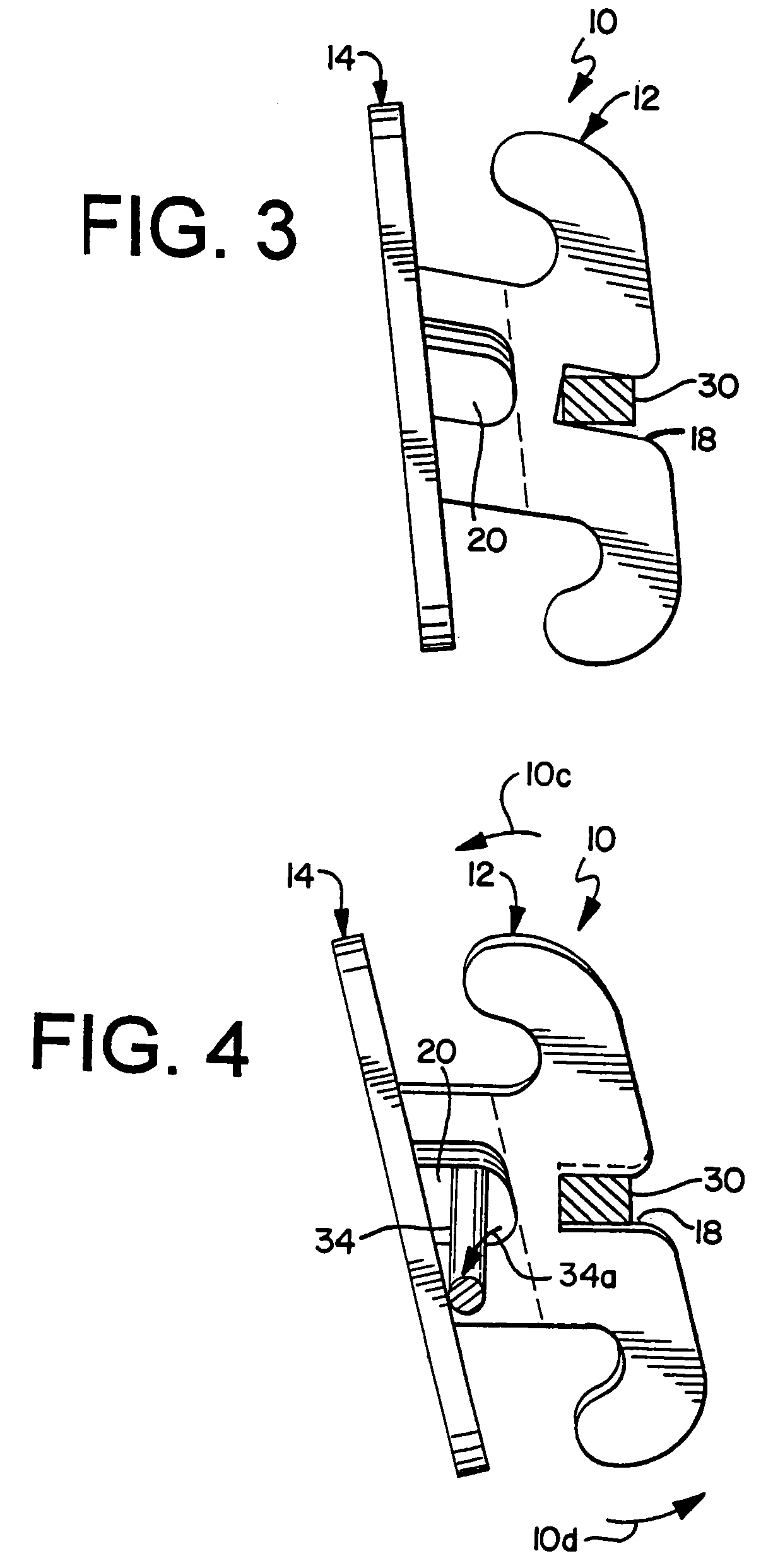 Edgewise orthodontic bracket for capturing lost torque