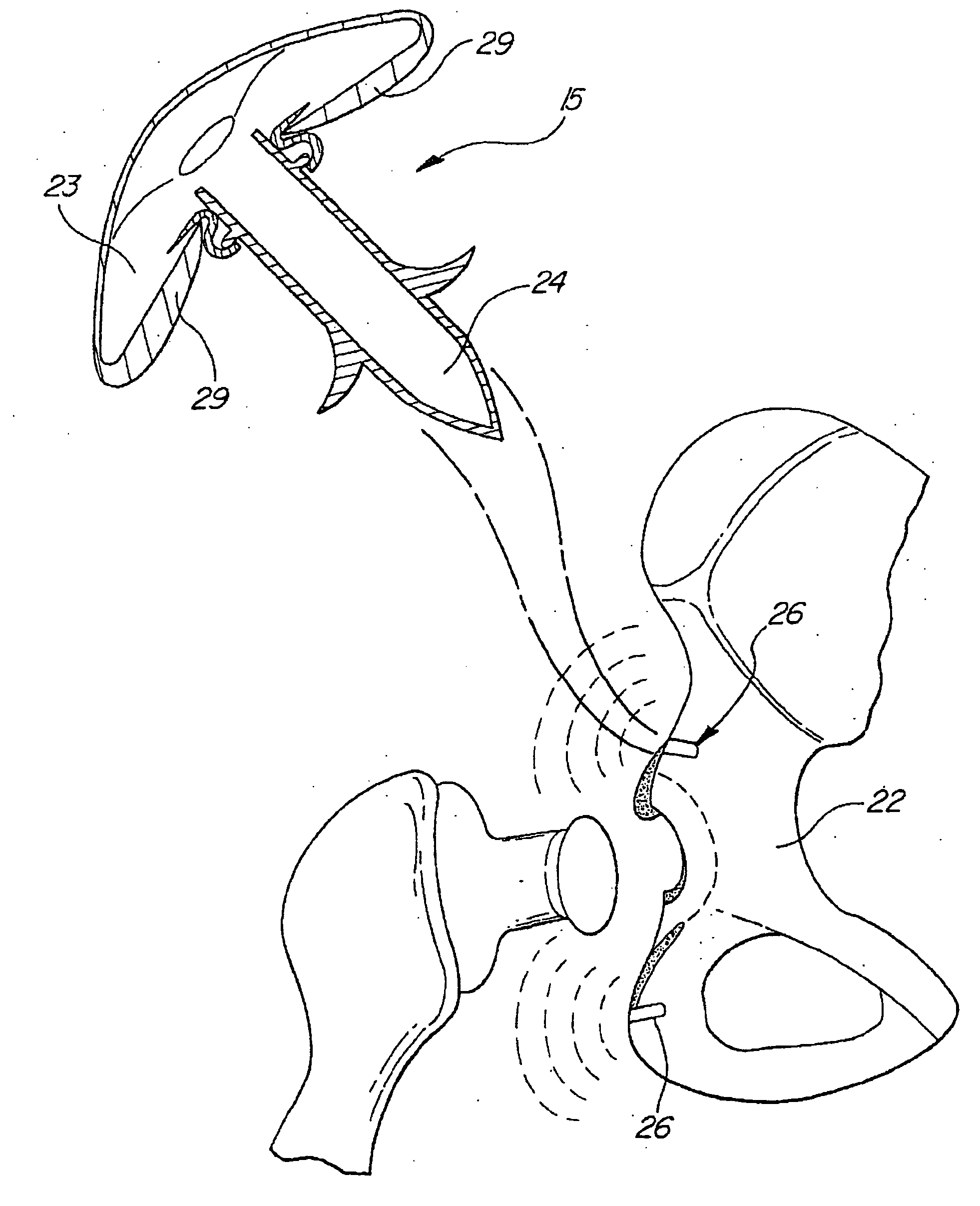 Directional-ionizing energy emitting implant