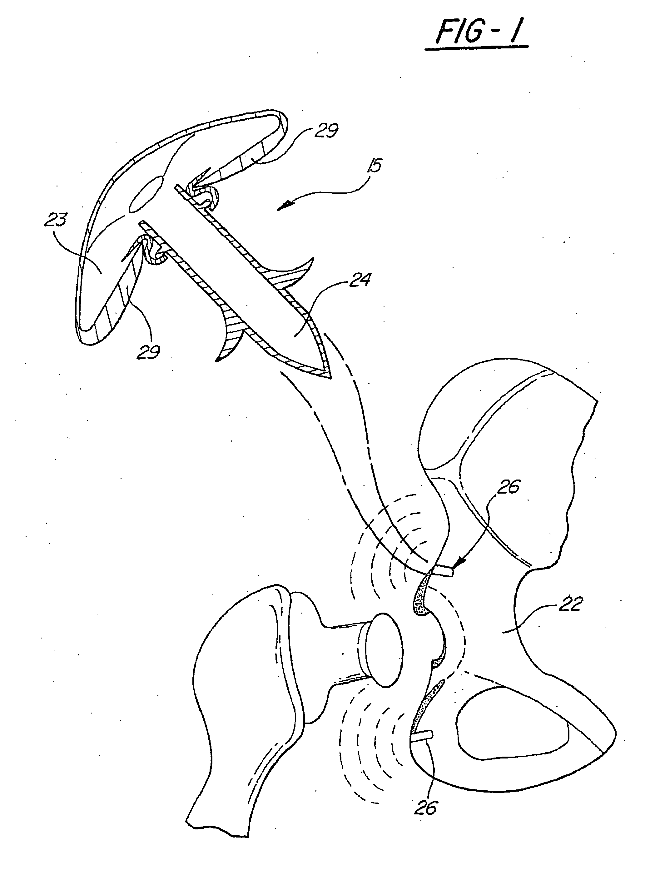 Directional-ionizing energy emitting implant