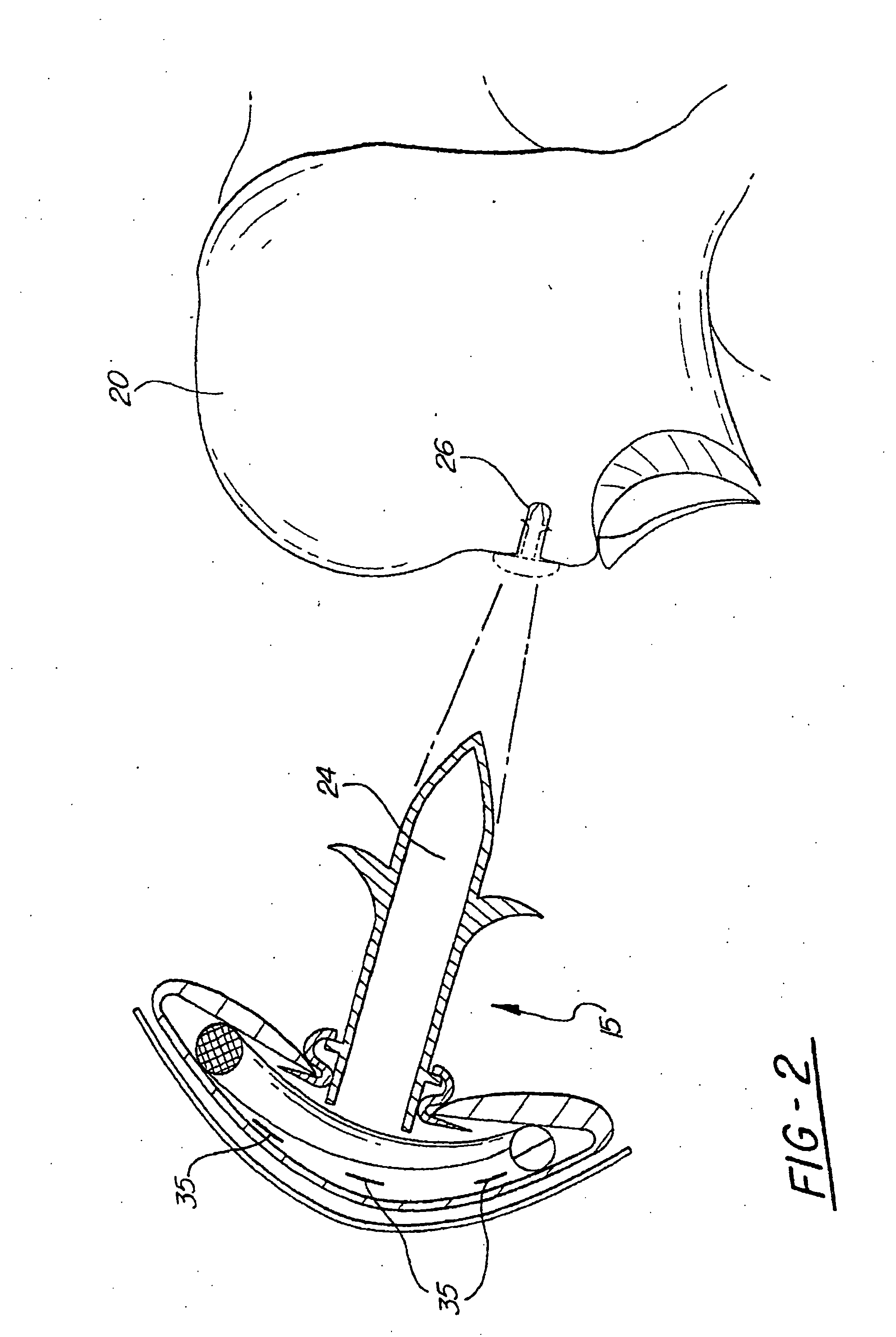 Directional-ionizing energy emitting implant