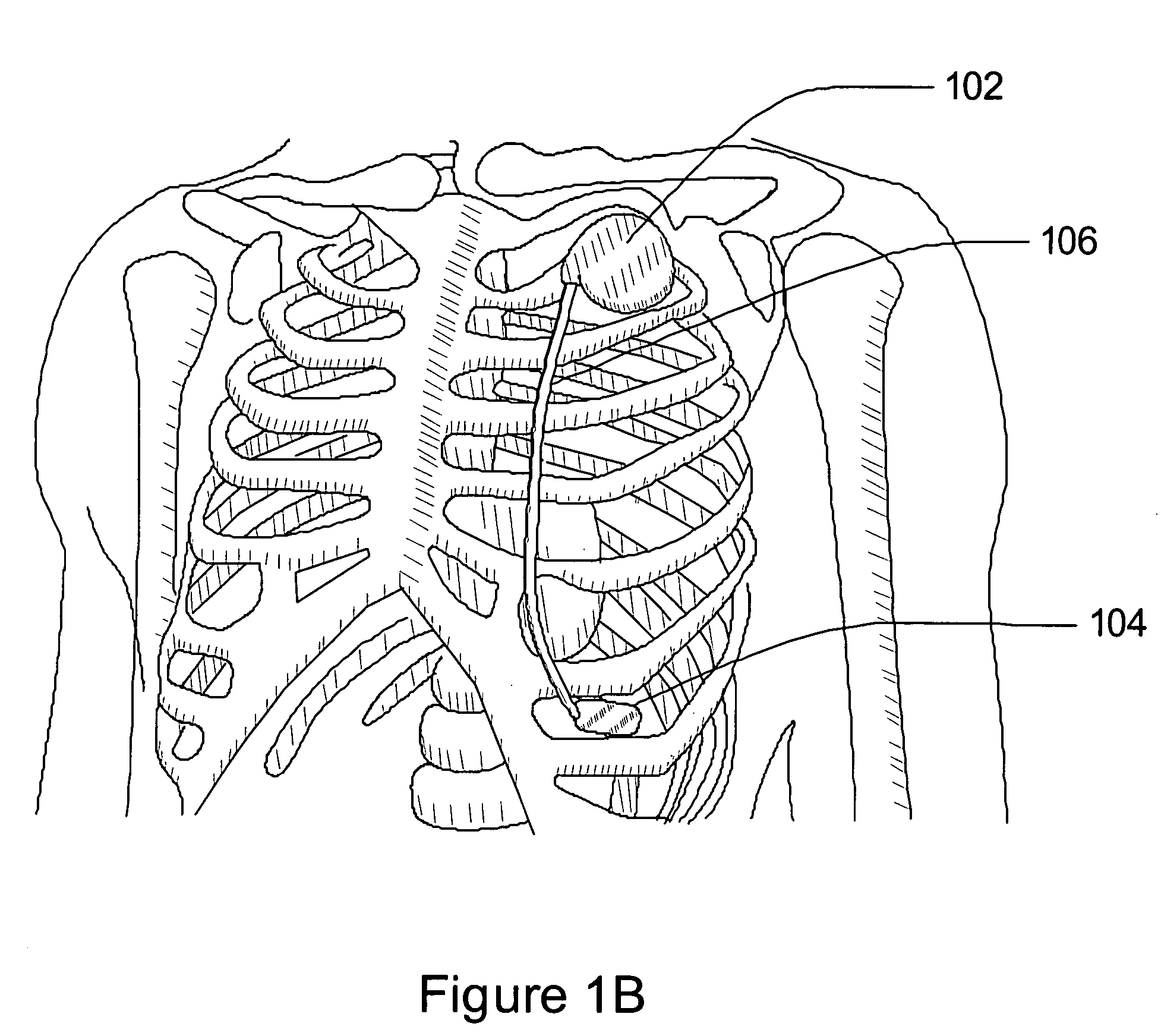 Separation of a subcutaneous cardiac signal from a plurality of composite signals