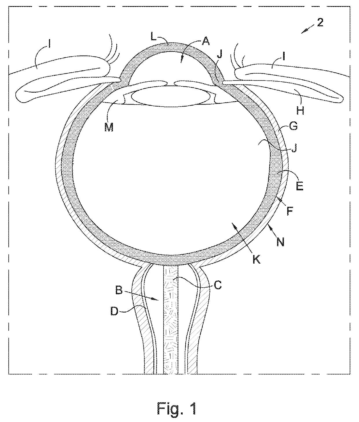 A shunt system, shunt and method for treating an ocular disorder