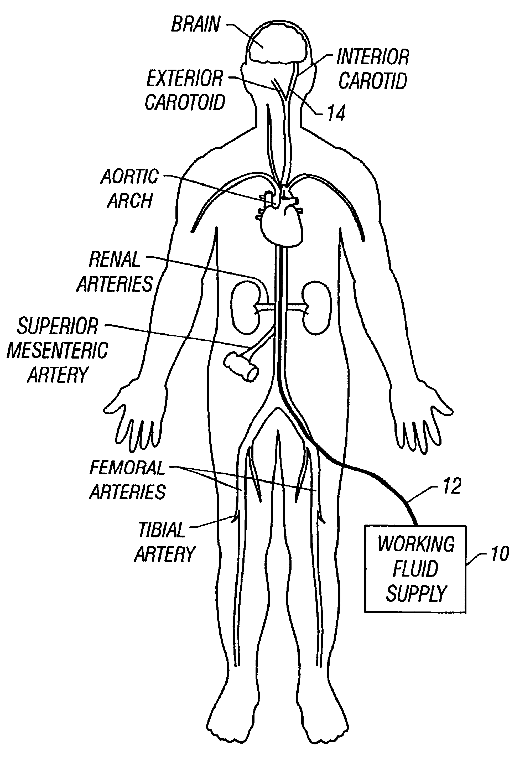 Method for low temperature thrombolysis and low temperature thrombolytic agent with selective organ temperature control