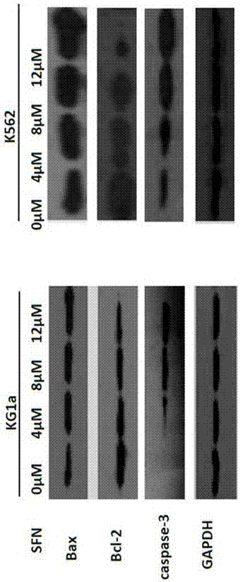 Application of SFN (sulforaphane) to preparation of medicine for treating leukemia