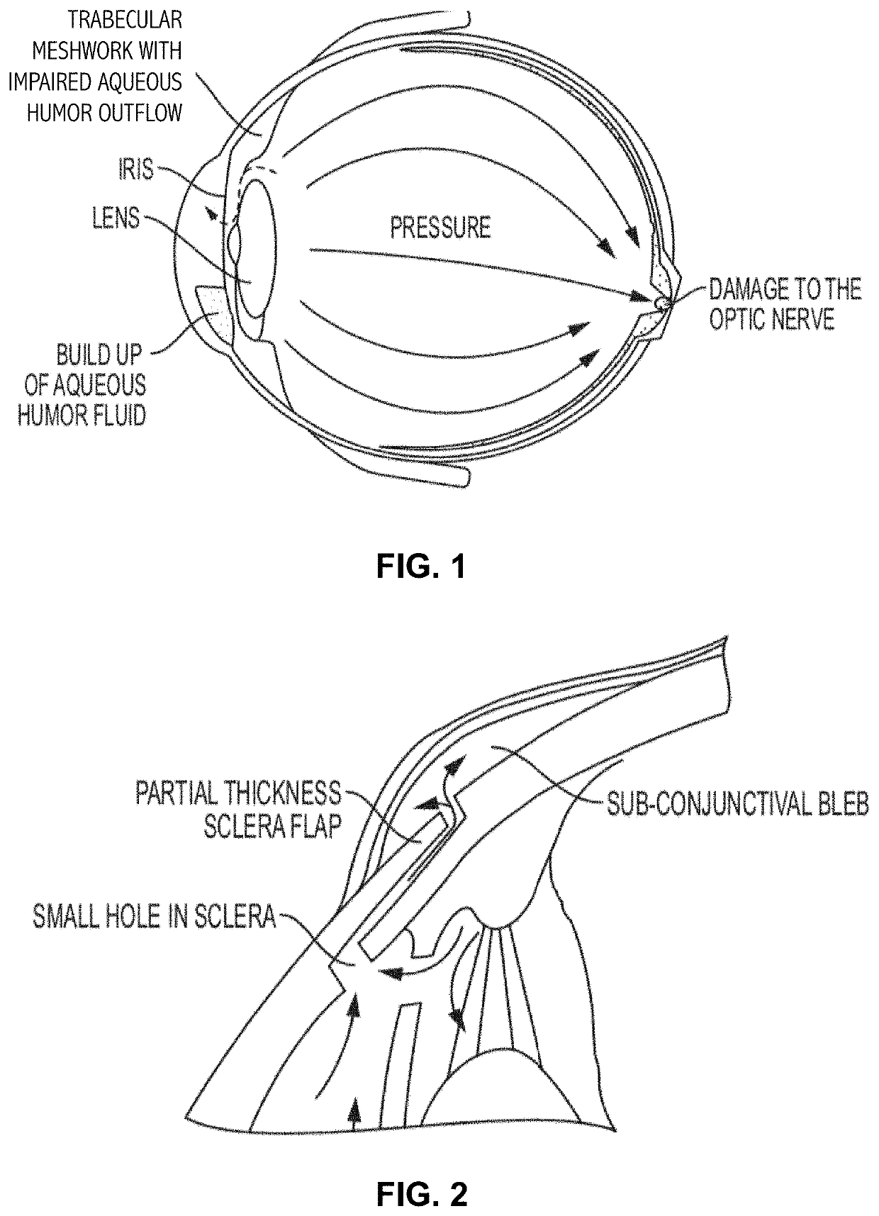 Methods, systems, and compositions for maintaining functioning drainage blebs associated with foreign bodies