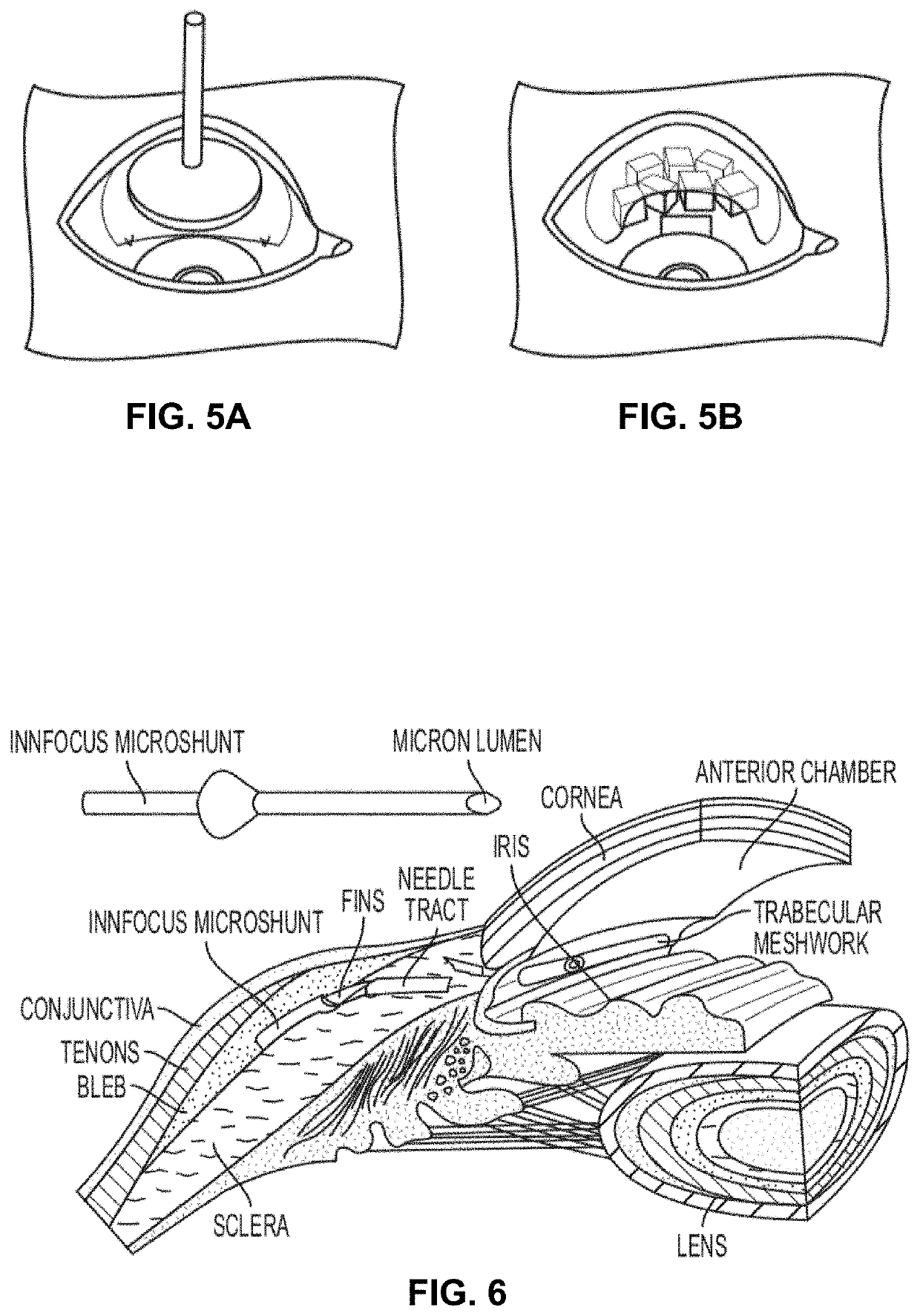 Methods, systems, and compositions for maintaining functioning drainage blebs associated with foreign bodies