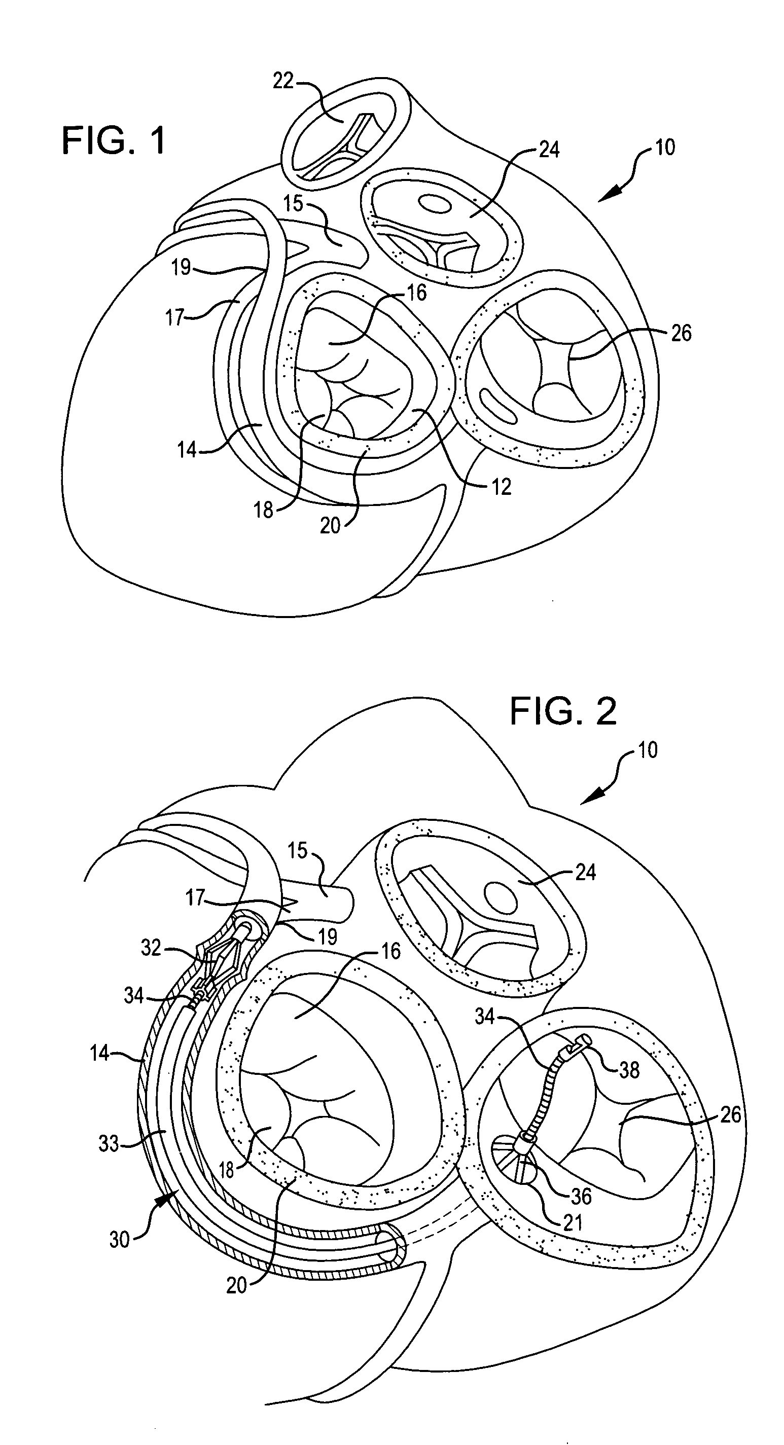 Anchor and pull mitral valve device and method