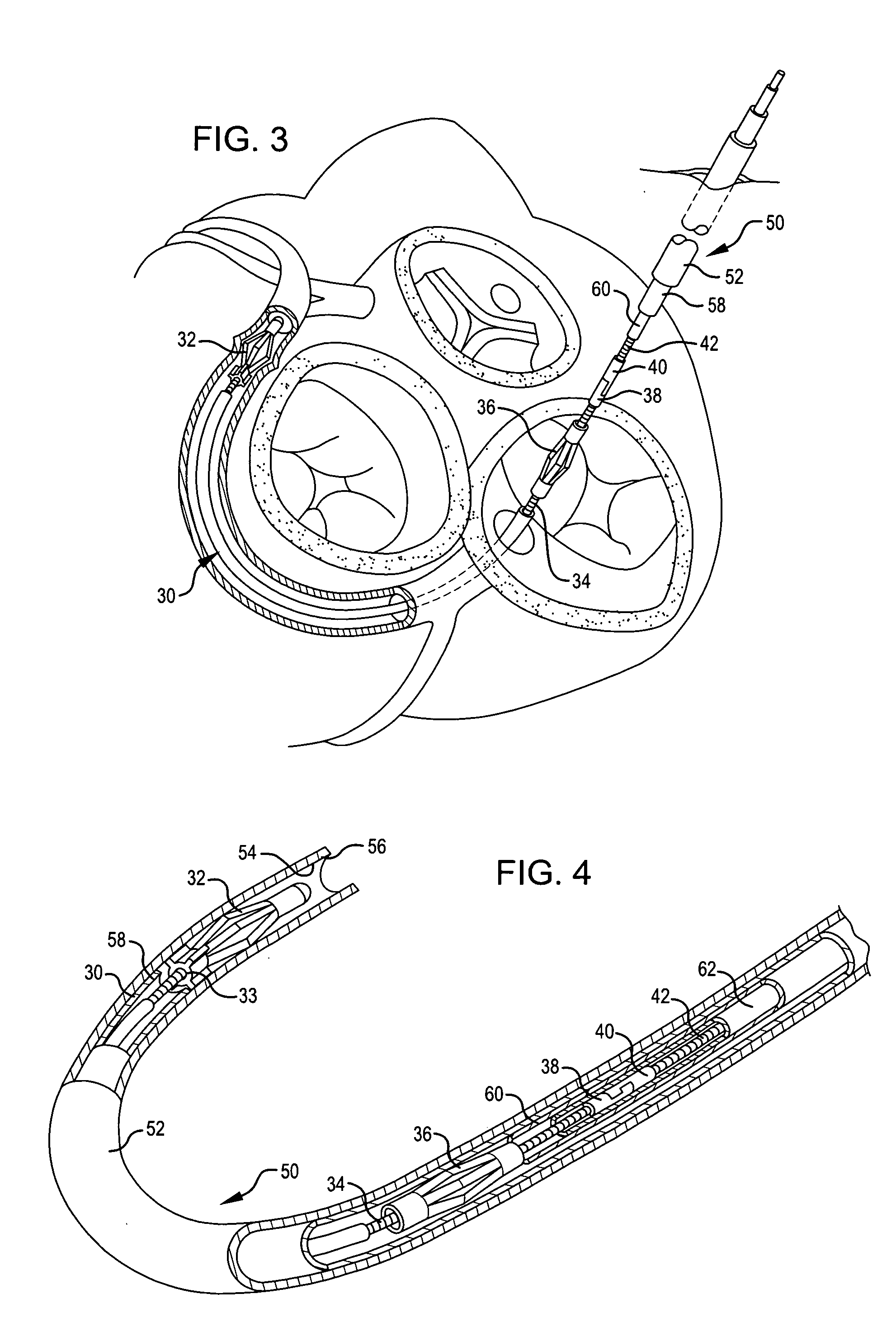 Anchor and pull mitral valve device and method