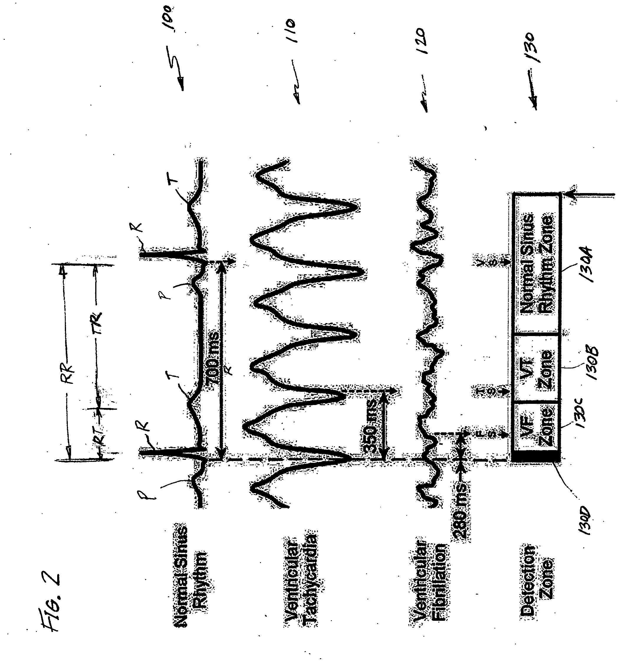 Implantable medical device with real time T-wave oversensing detection