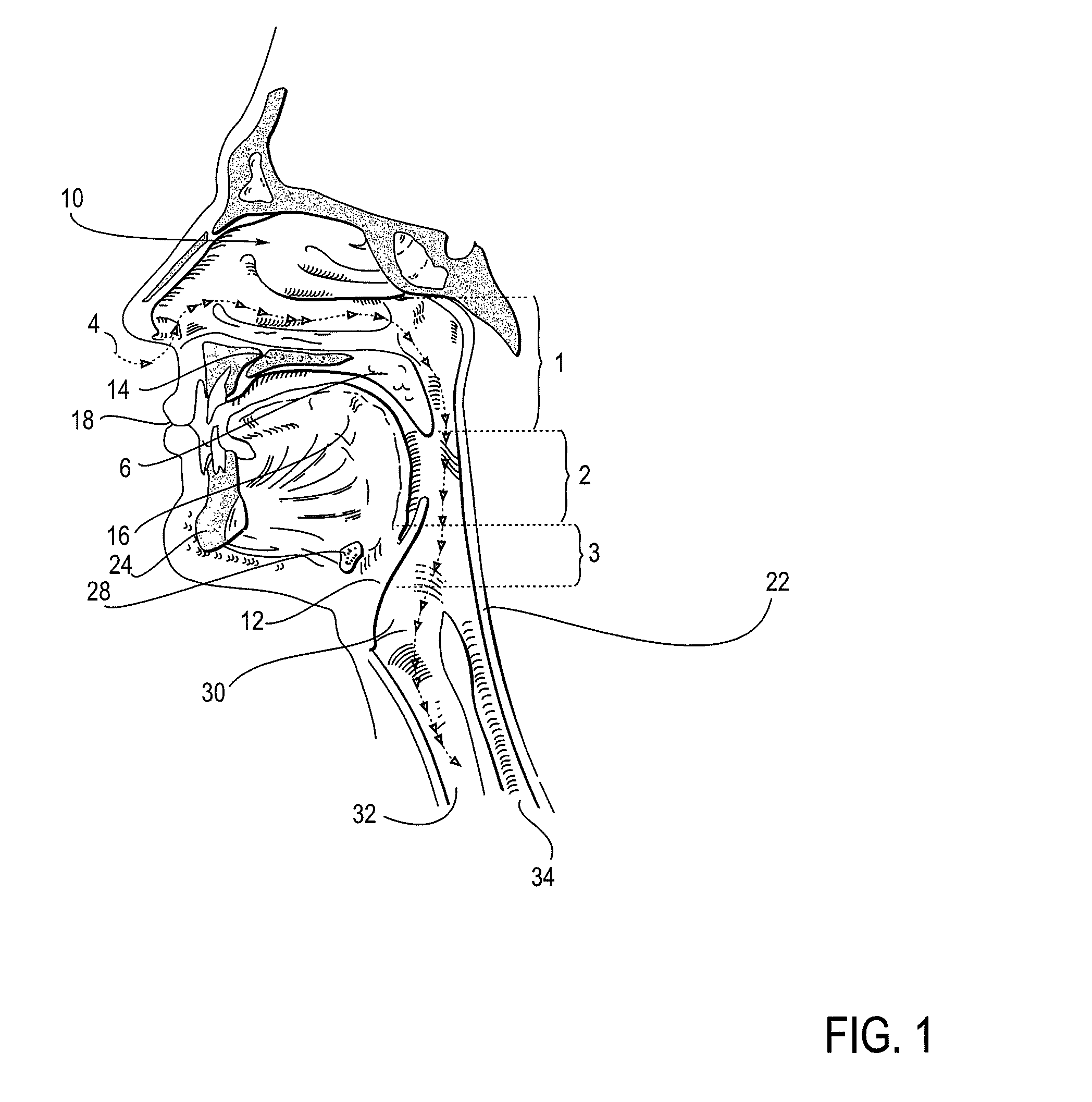 Partially erodable systems for treatment of obstructive sleep apnea