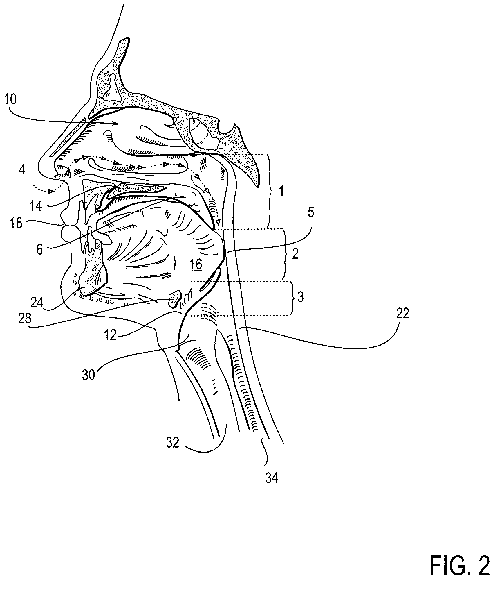 Partially erodable systems for treatment of obstructive sleep apnea