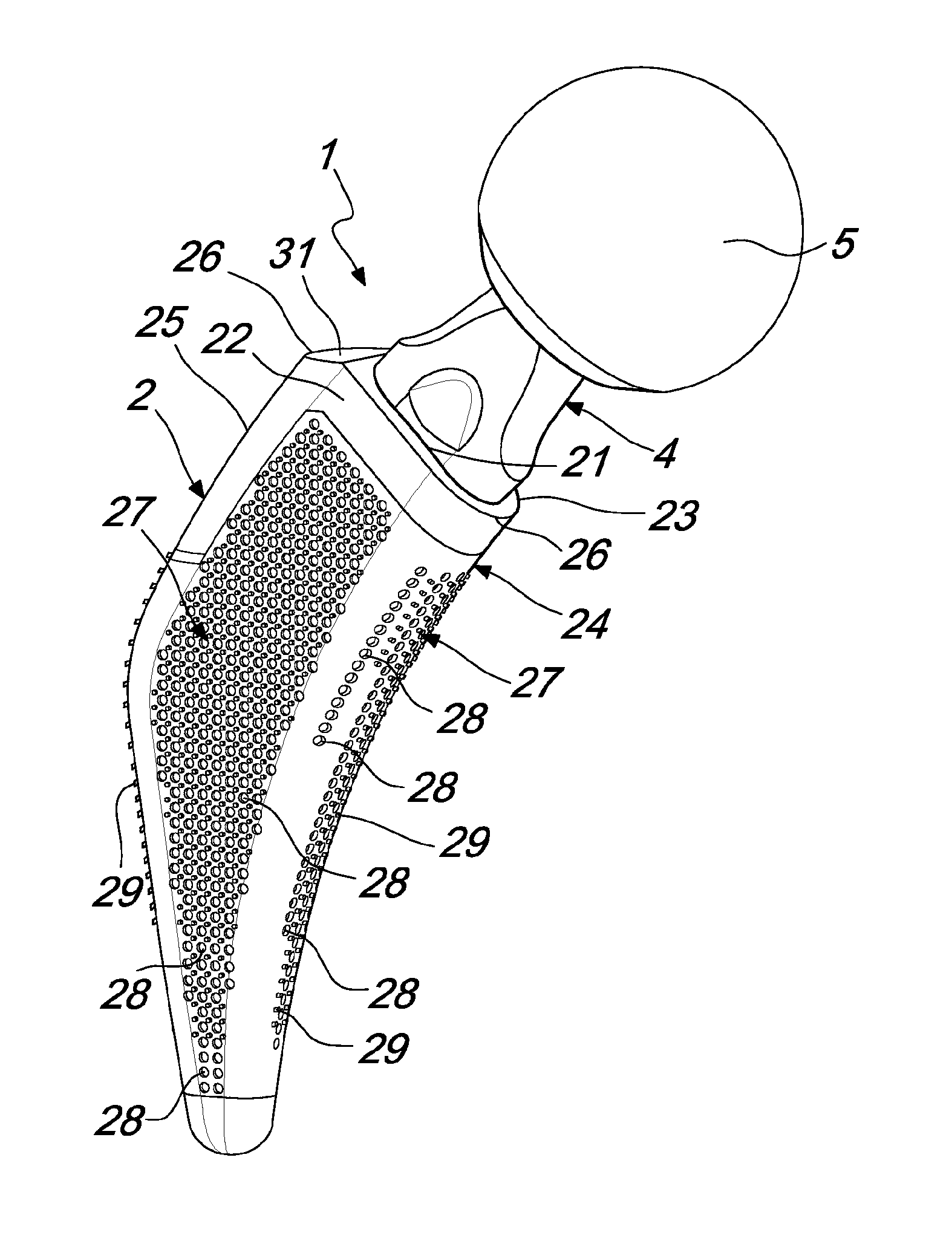 Modular prosthetic device for hip joint replacement