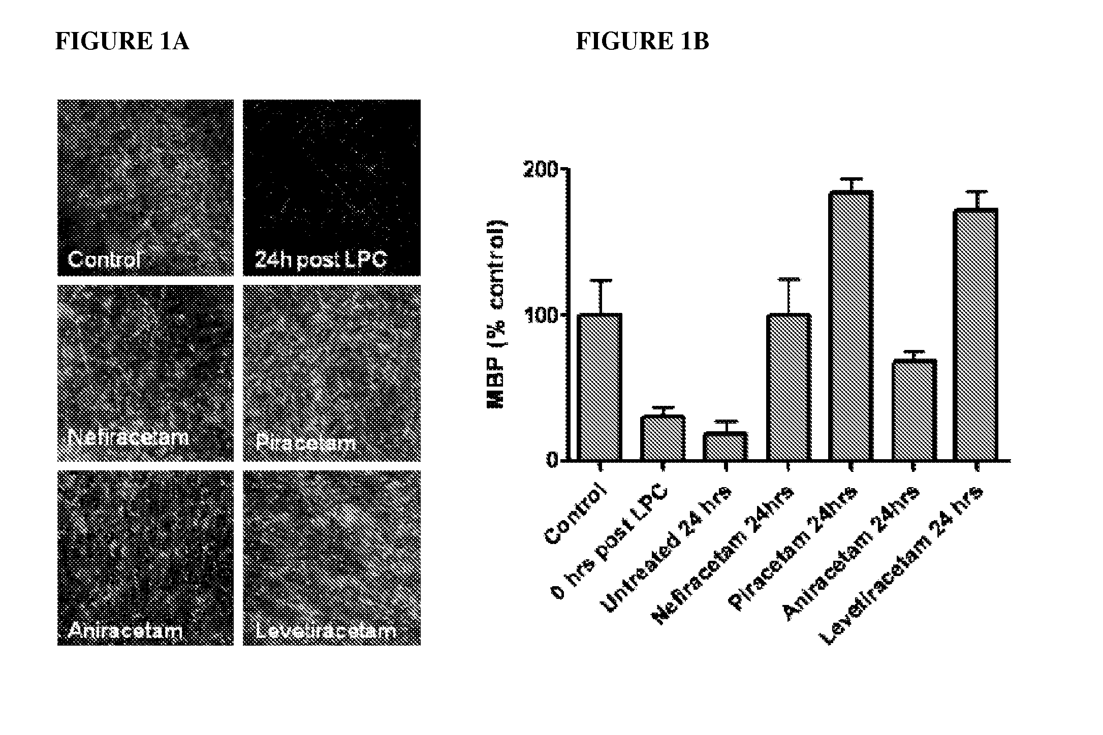 Causal therapy of diseases or conditions associated with CNS or pns demyelination