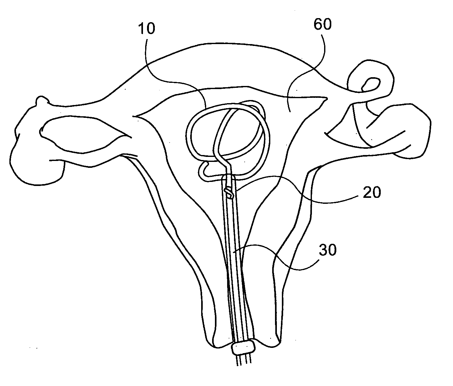 Novel intra uterine device