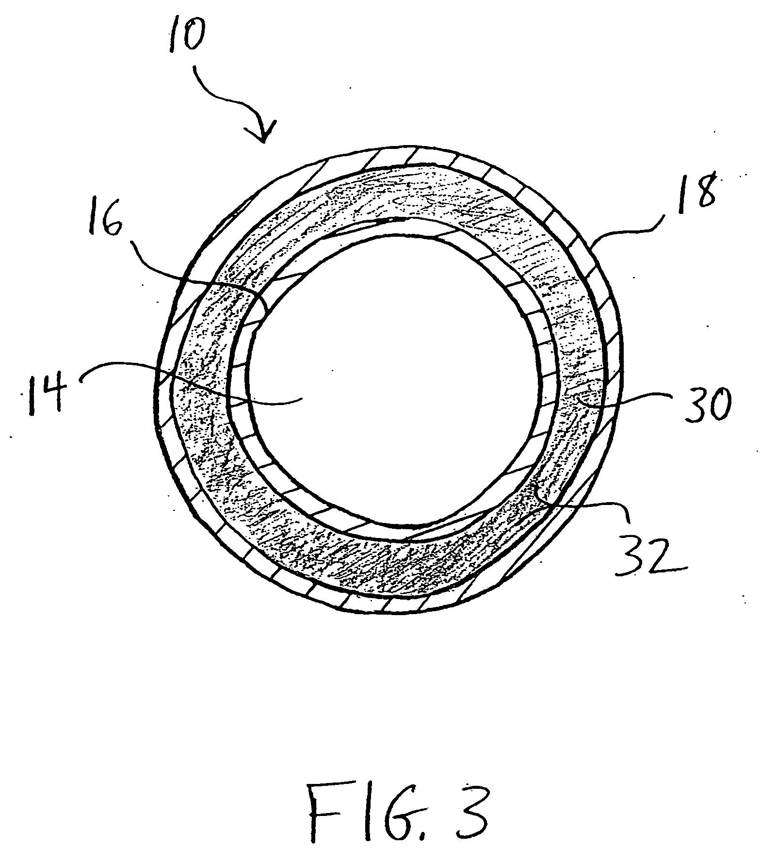 Inflatable biliary stent