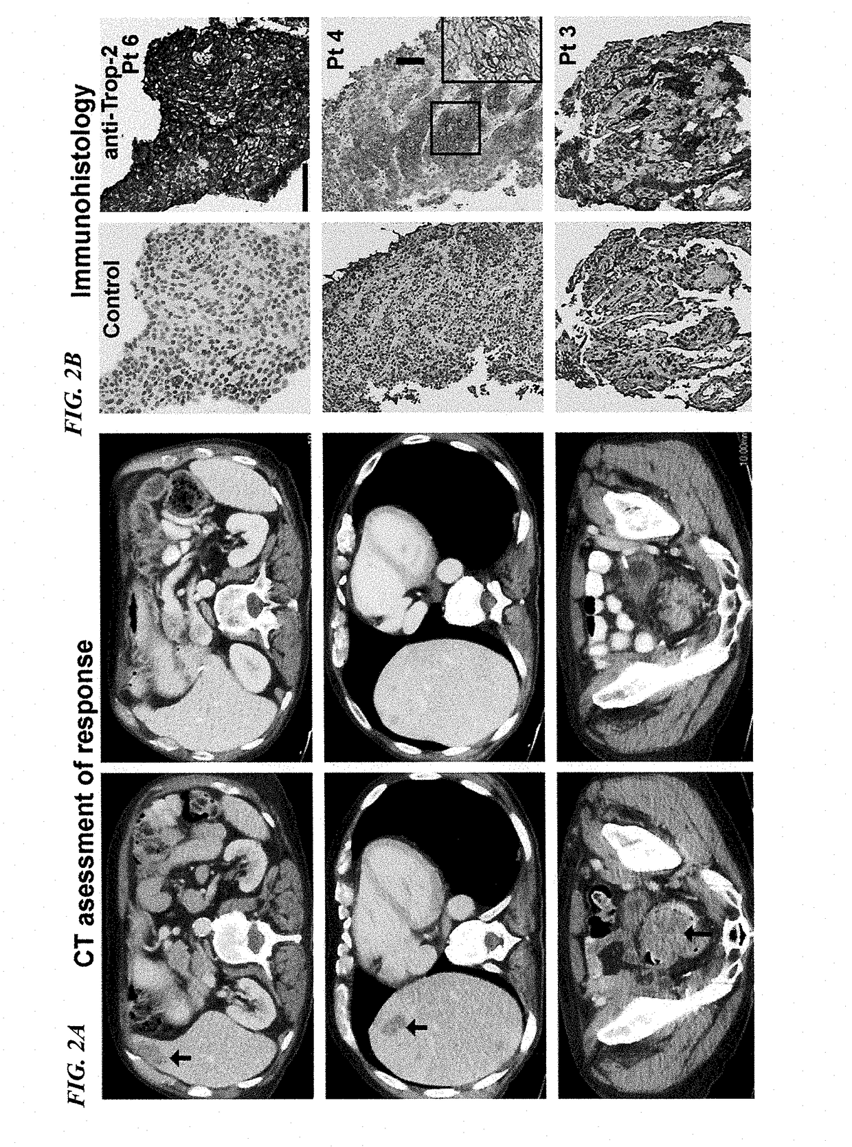 Therapy for metastatic urothelial cancer with the antibody-drug conjugate, sacituzumab govitecan (immu-132)